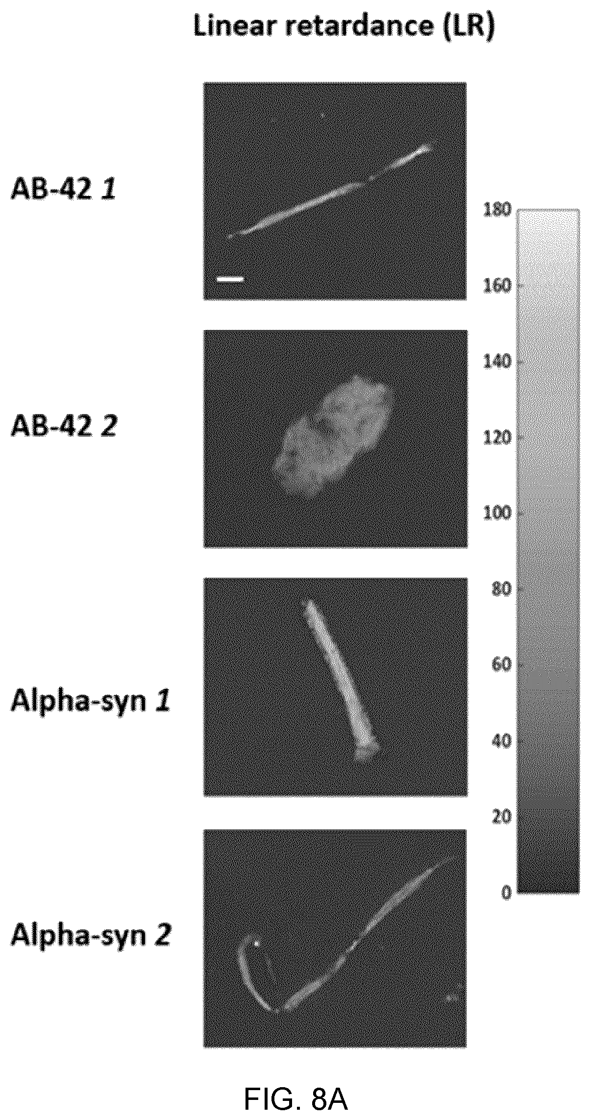 Patent US12417540 Figure 14 – Methods and apparatus for imaging, analysing images and classifying presumed protein deposits in the retina