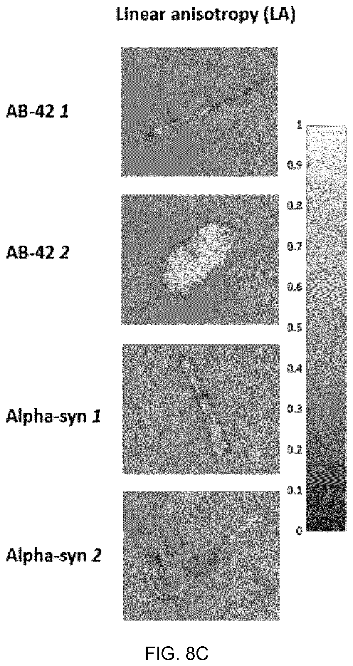 Patent US12417540 Figure 16 – Methods and apparatus for imaging, analysing images and classifying presumed protein deposits in the retina