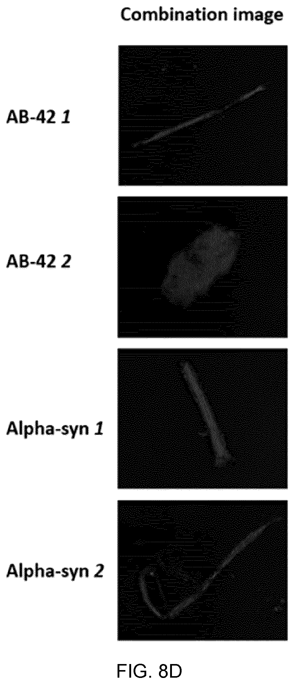 Patent US12417540 Figure 17 – Methods and apparatus for imaging, analysing images and classifying presumed protein deposits in the retina