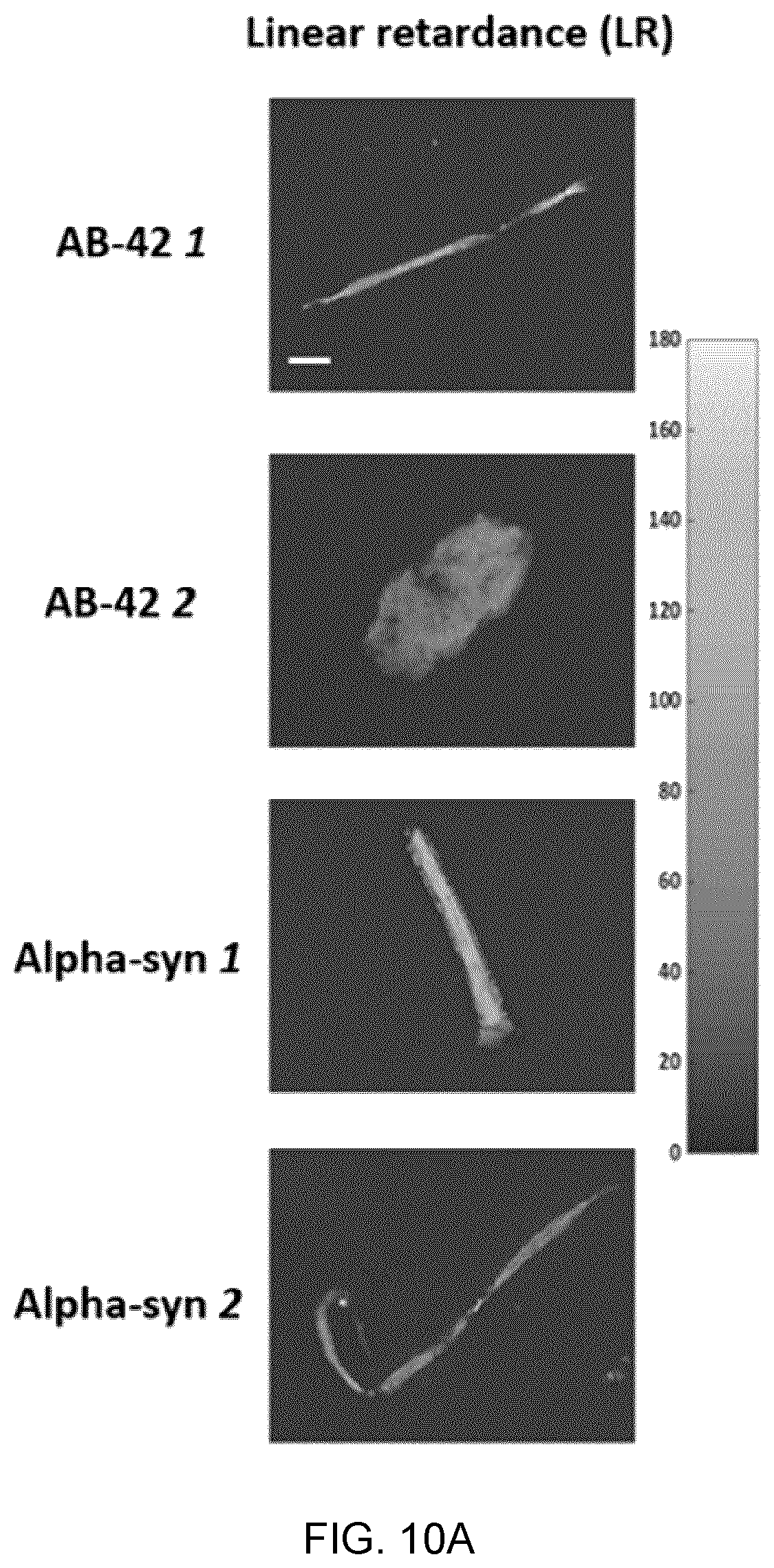 Patent US12417540 Figure 19 – Methods and apparatus for imaging, analysing images and classifying presumed protein deposits in the retina