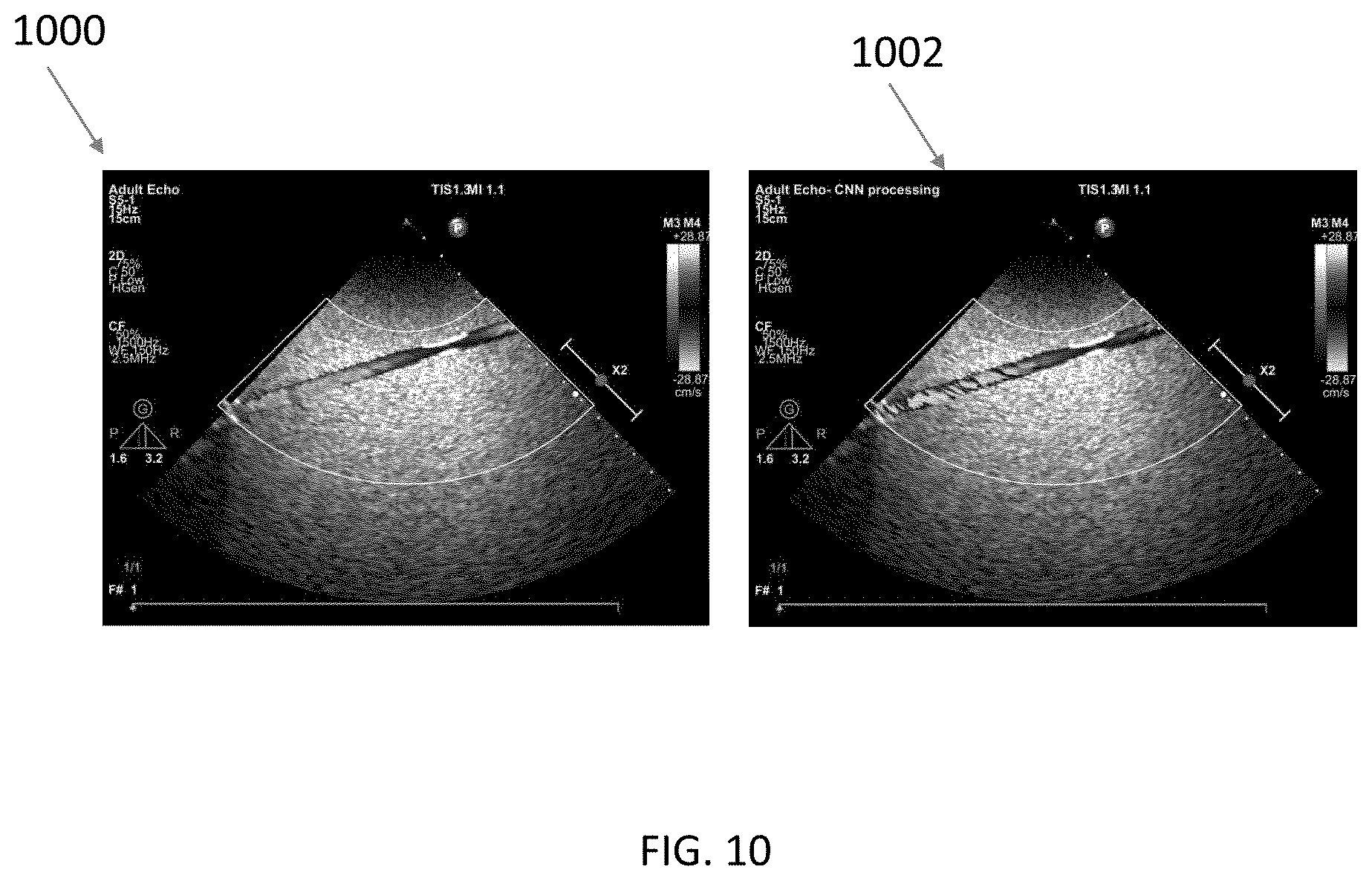 Patent US12422548 Figure 10 – Systems and methods for generating color doppler images from short and undersampled ensembles