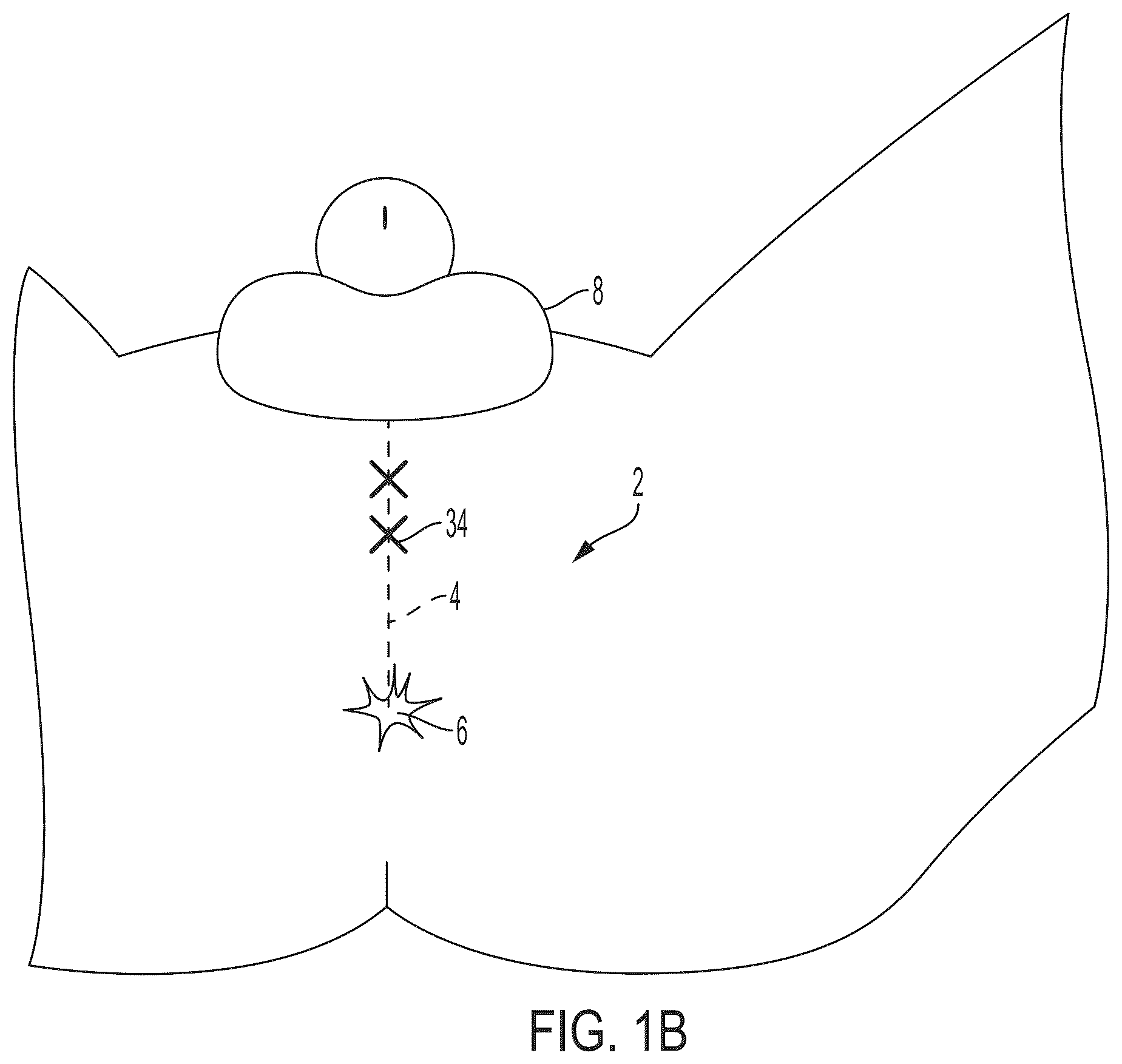 Patent US12426594 Figure 2 – Cryoprotective compositions and methods for protection of a surgical site during cryosurgery