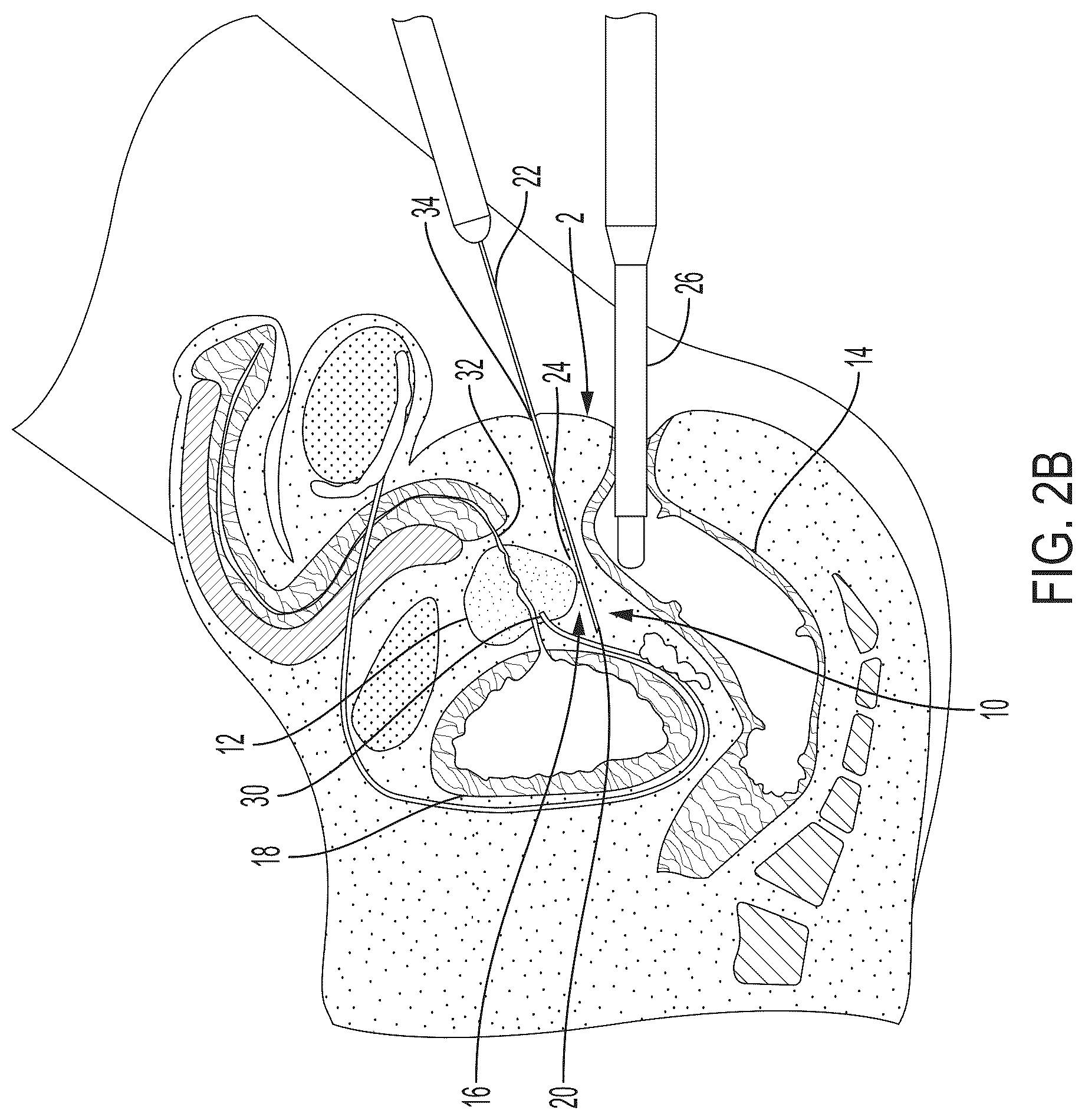 Patent US12426594 Figure 4 – Cryoprotective compositions and methods for protection of a surgical site during cryosurgery