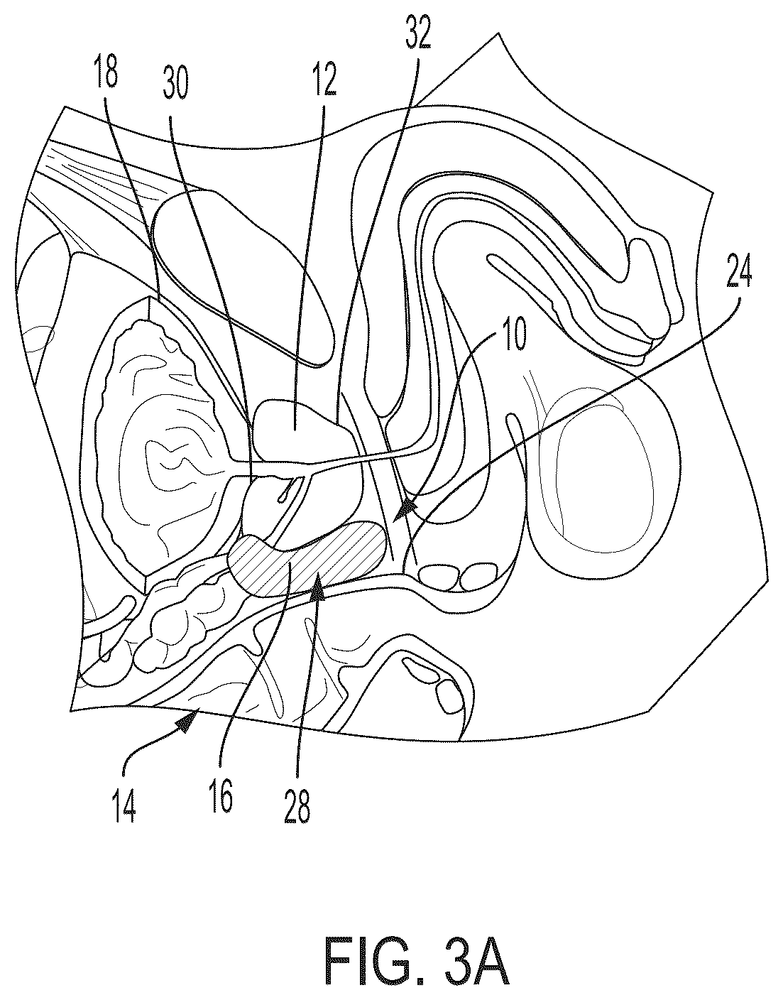 Patent US12426594 Figure 5 – Cryoprotective compositions and methods for protection of a surgical site during cryosurgery