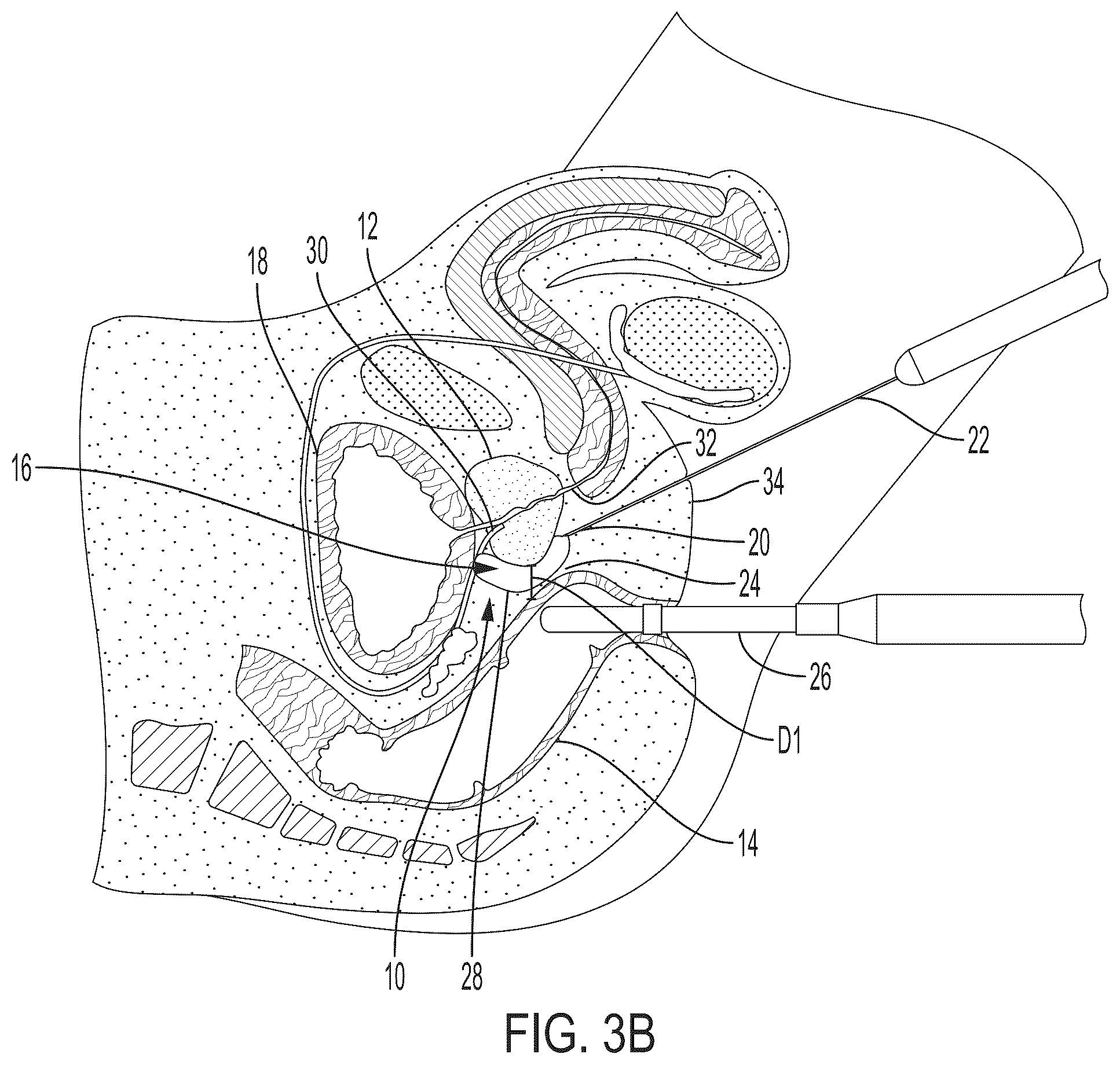 Patent US12426594 Figure 6 – Cryoprotective compositions and methods for protection of a surgical site during cryosurgery