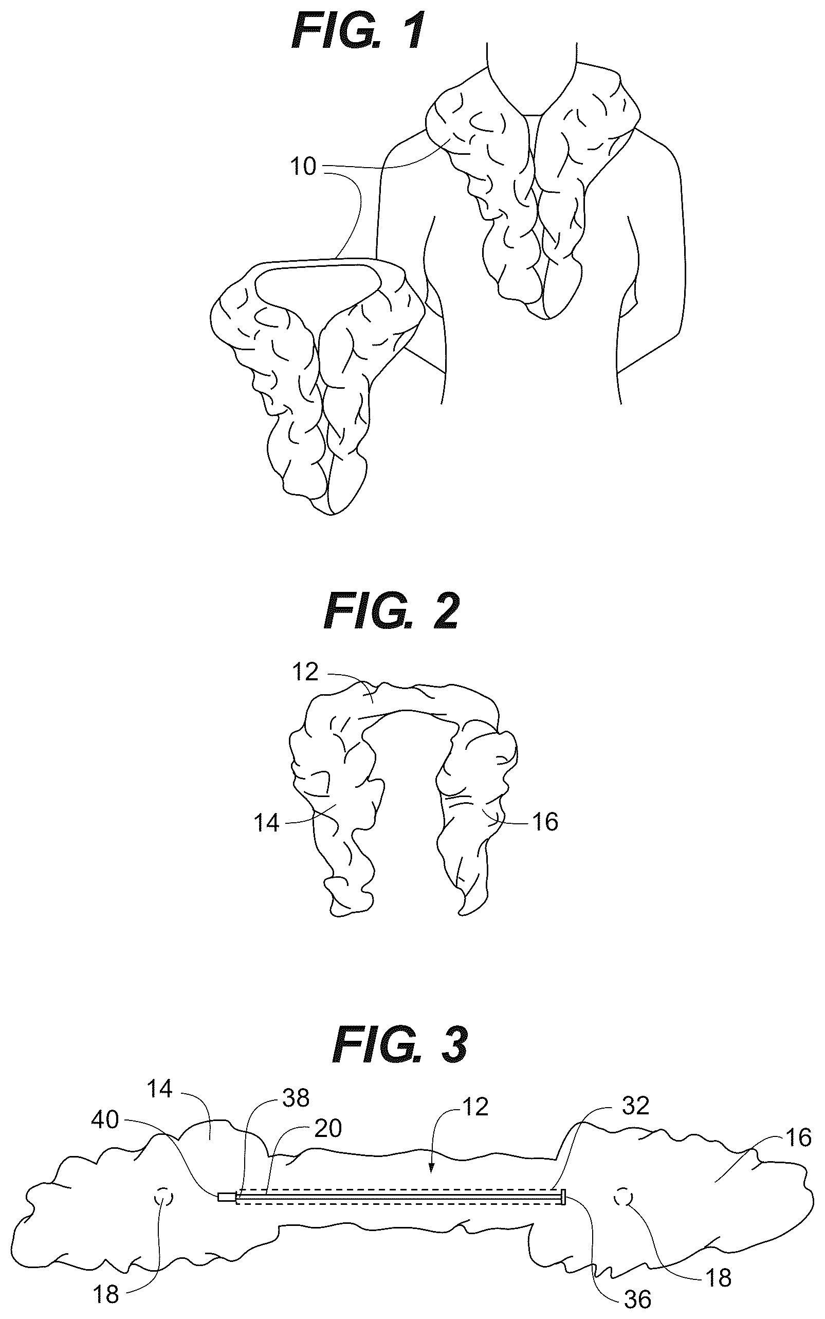 Patent US12426653 Figure 1 – Pre-configured scarf with built-in closure
