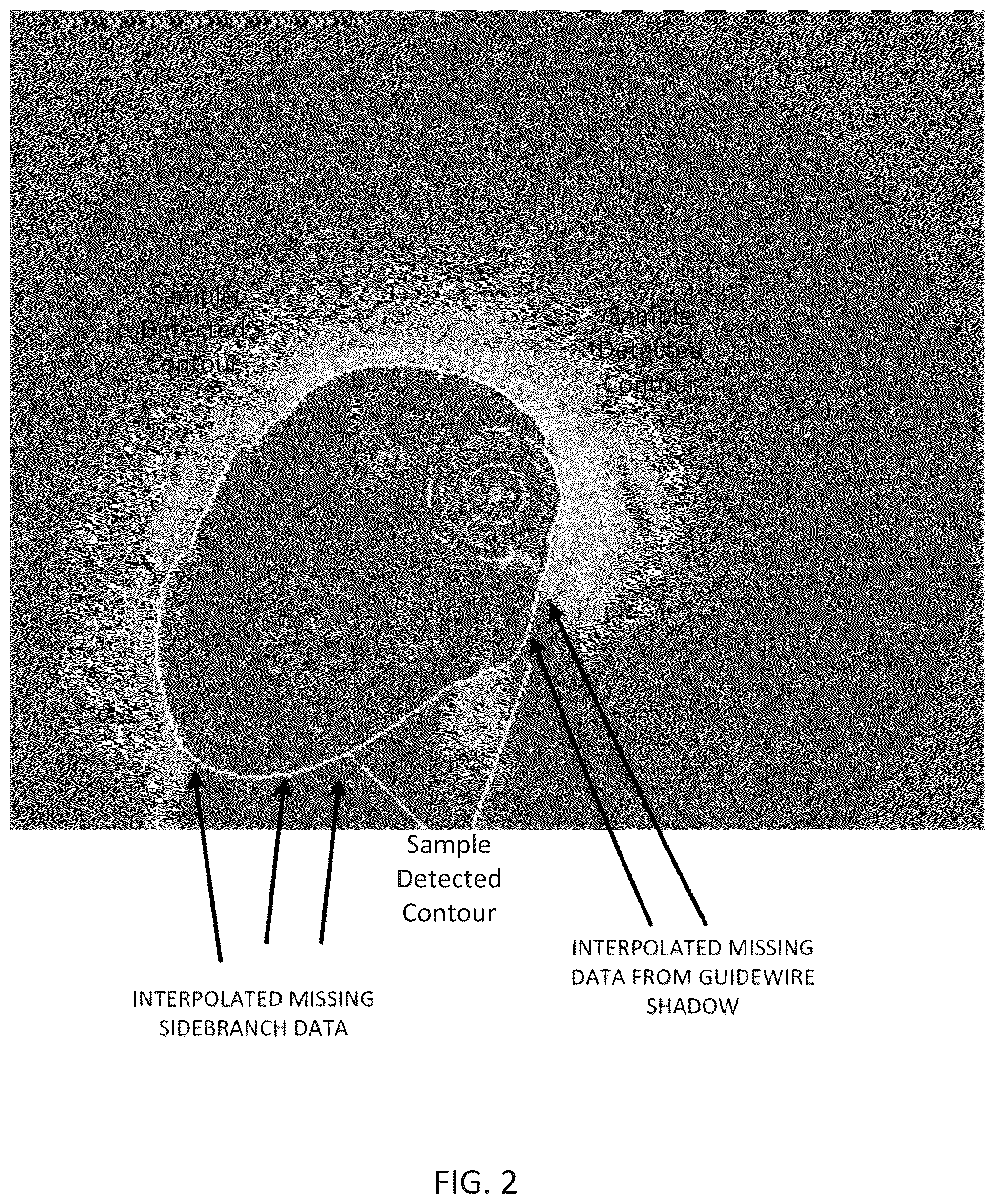 Patent US12426789 Figure 3 – Blood vessel lumen morphology and minimum lumen area measurements data collection by intravascular imaging systems for stenosis or stent planning