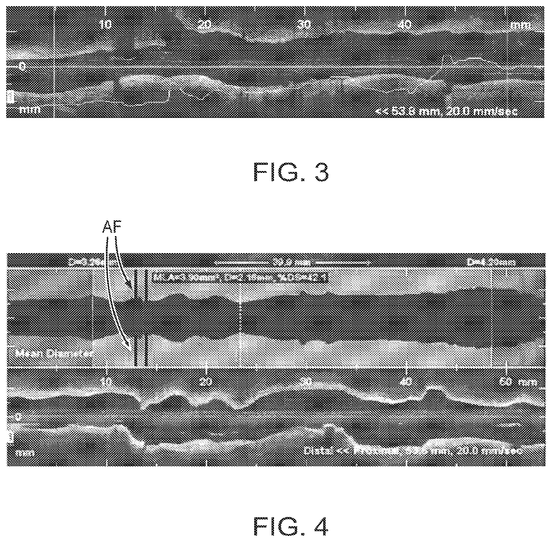 Patent US12426789 Figure 4 – Blood vessel lumen morphology and minimum lumen area measurements data collection by intravascular imaging systems for stenosis or stent planning