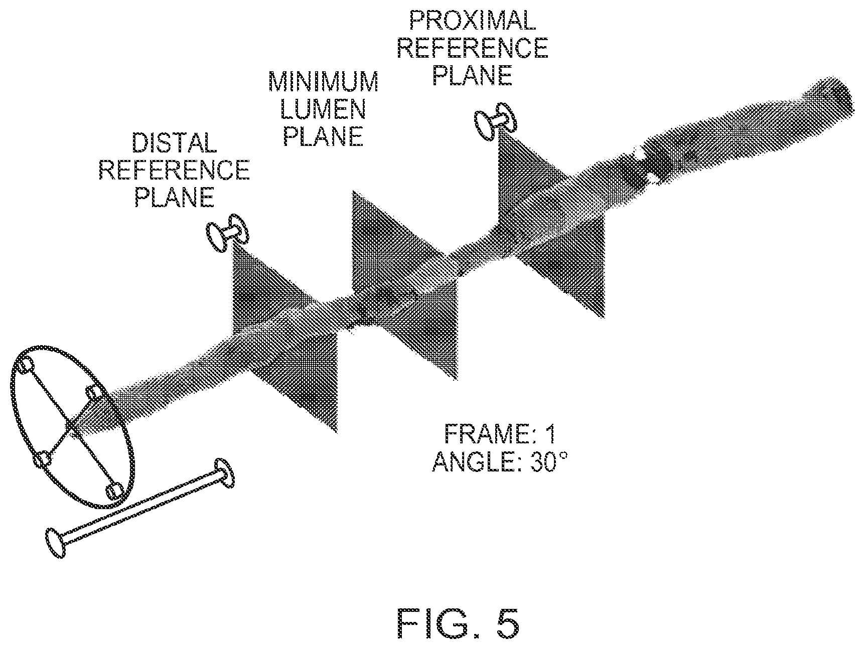 Patent US12426789 Figure 5 – Blood vessel lumen morphology and minimum lumen area measurements data collection by intravascular imaging systems for stenosis or stent planning