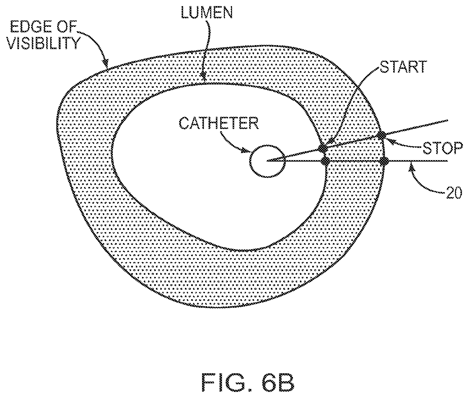 Patent US12426789 Figure 7 – Blood vessel lumen morphology and minimum lumen area measurements data collection by intravascular imaging systems for stenosis or stent planning