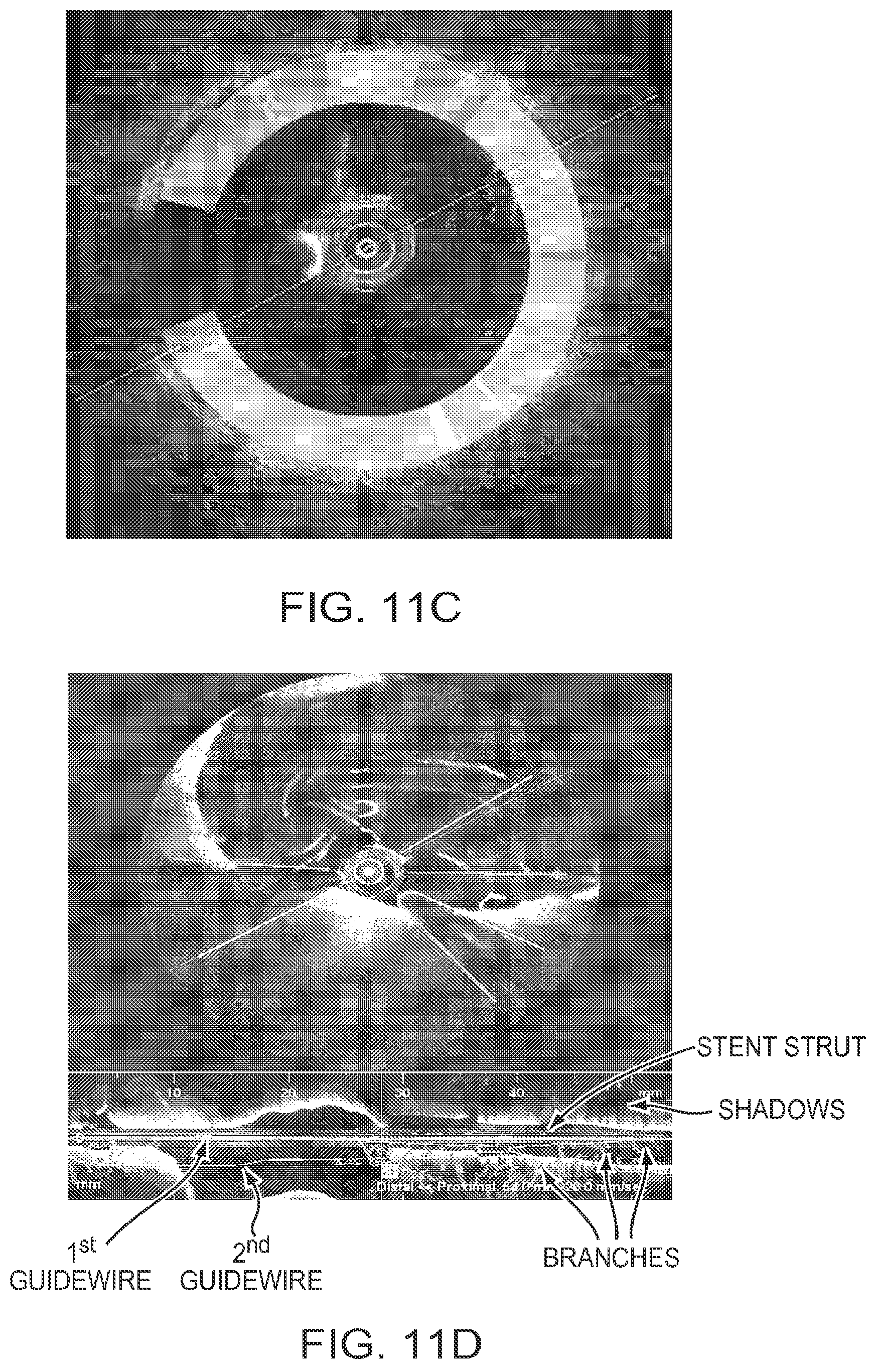 Patent US12426789 Figure 11 – Blood vessel lumen morphology and minimum lumen area measurements data collection by intravascular imaging systems for stenosis or stent planning