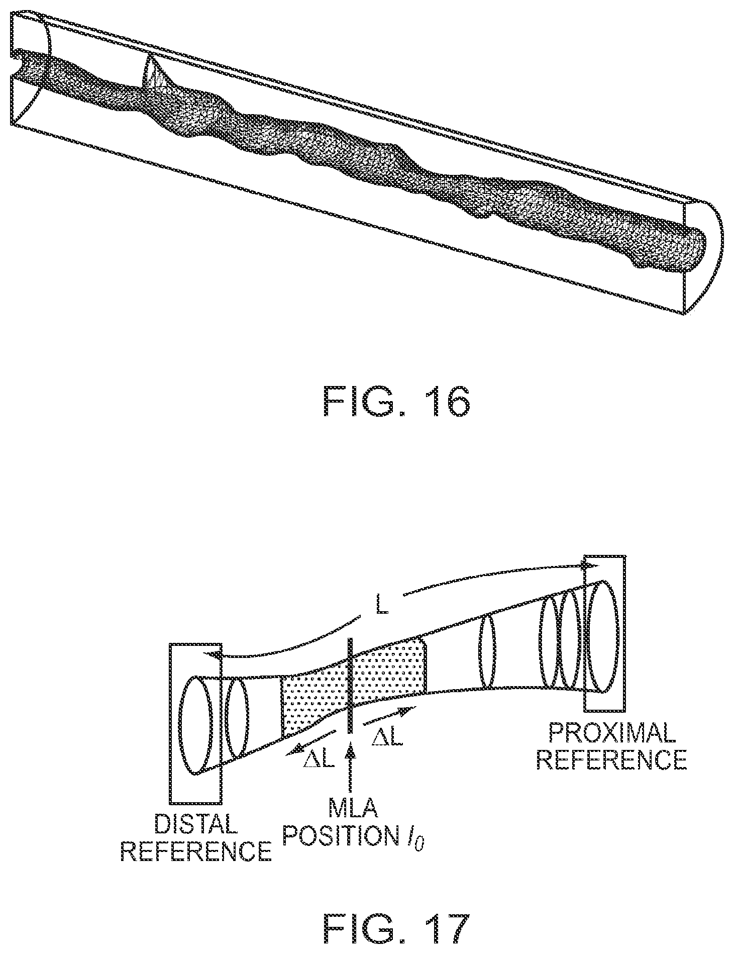 Patent US12426789 Figure 15 – Blood vessel lumen morphology and minimum lumen area measurements data collection by intravascular imaging systems for stenosis or stent planning