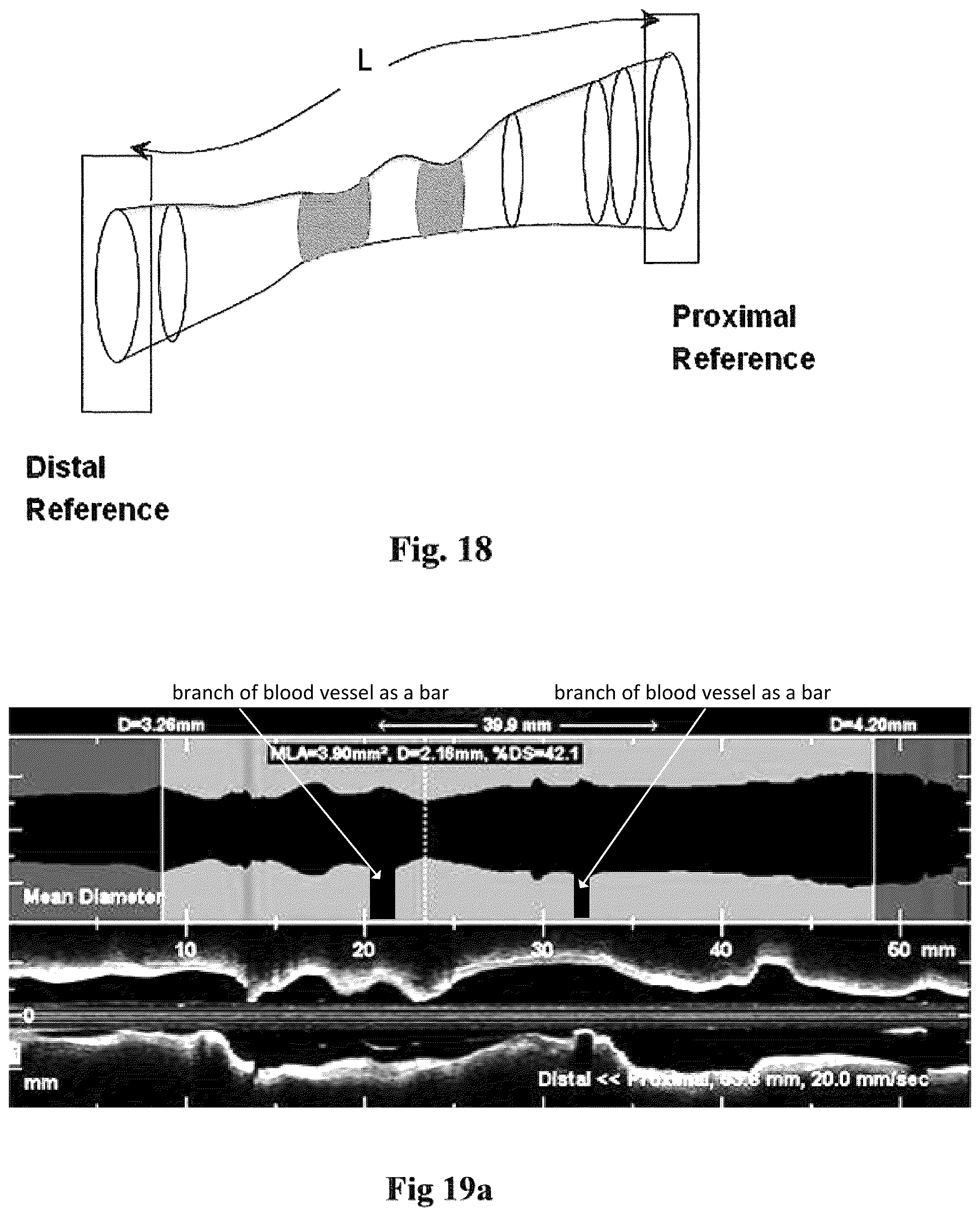 Patent US12426789 Figure 16 – Blood vessel lumen morphology and minimum lumen area measurements data collection by intravascular imaging systems for stenosis or stent planning