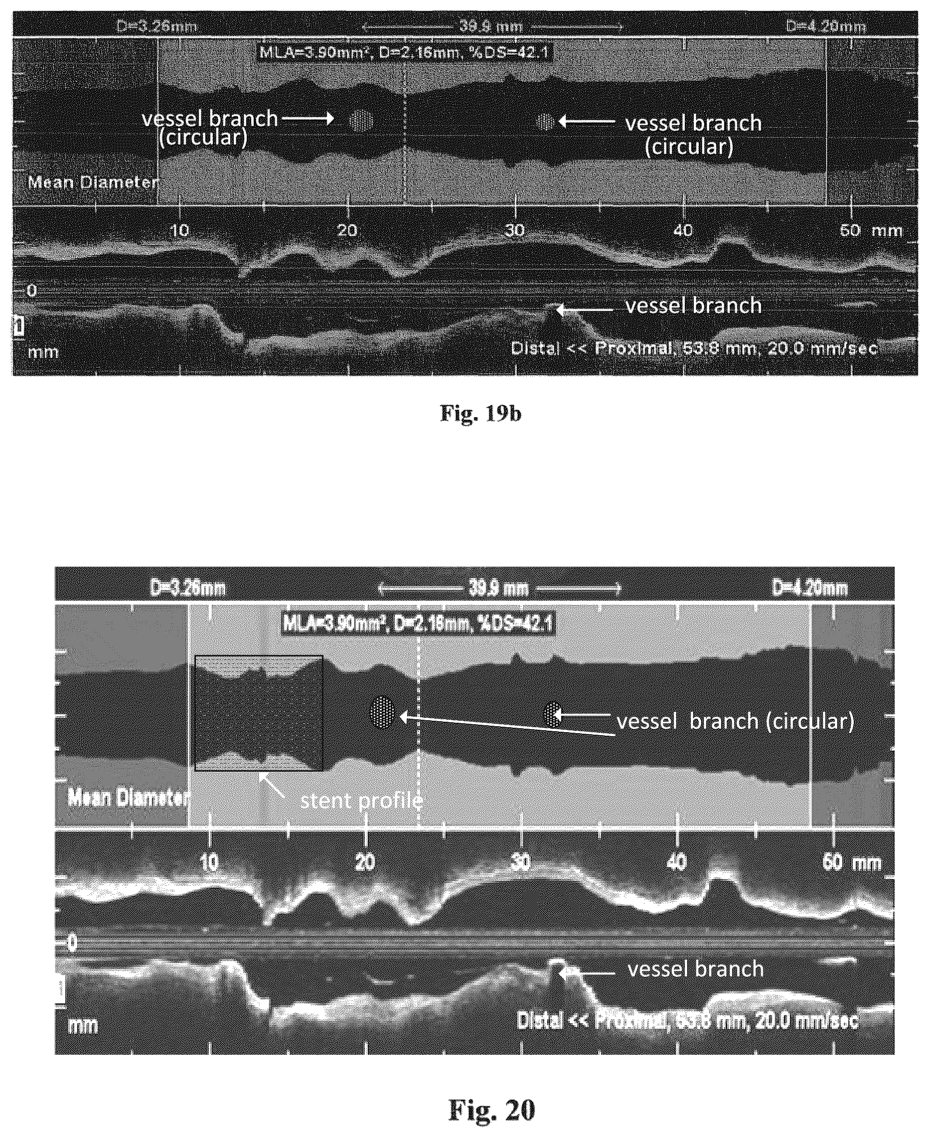 Patent US12426789 Figure 17 – Blood vessel lumen morphology and minimum lumen area measurements data collection by intravascular imaging systems for stenosis or stent planning
