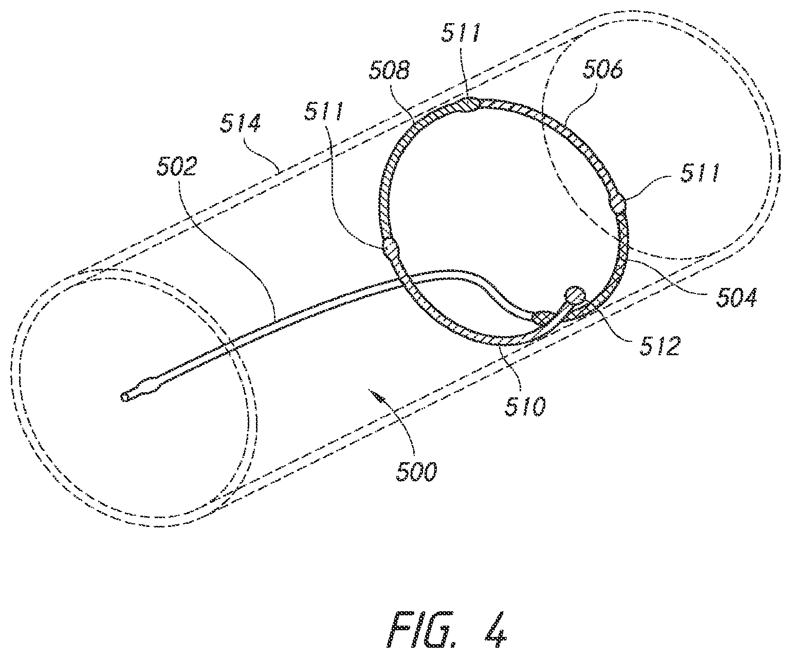 Patent US12426803 Figure 5 – Endoluminal sizing device