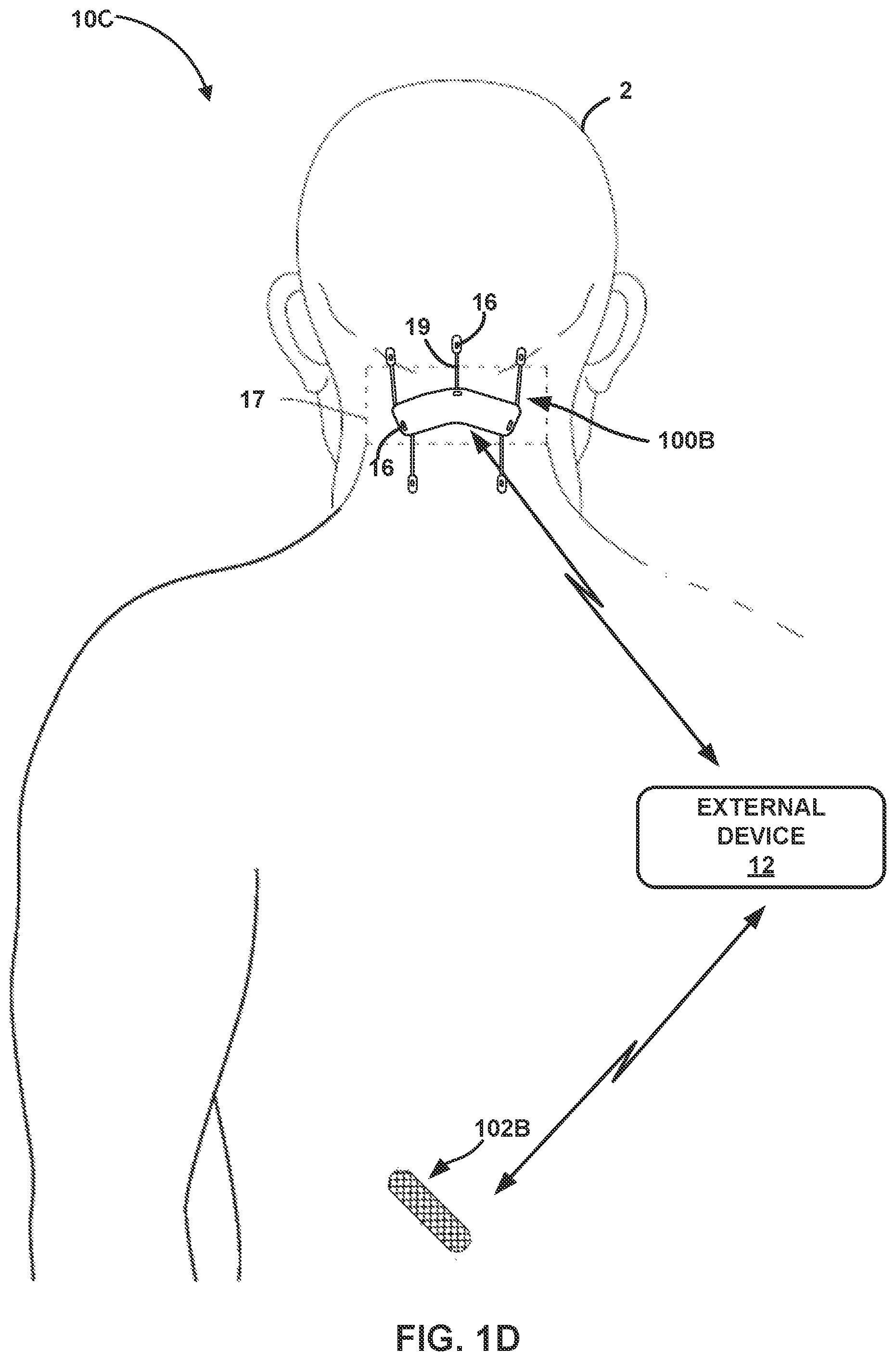 Patent US12426811 Figure 4 – Detection of changes in patient health based on glucose data