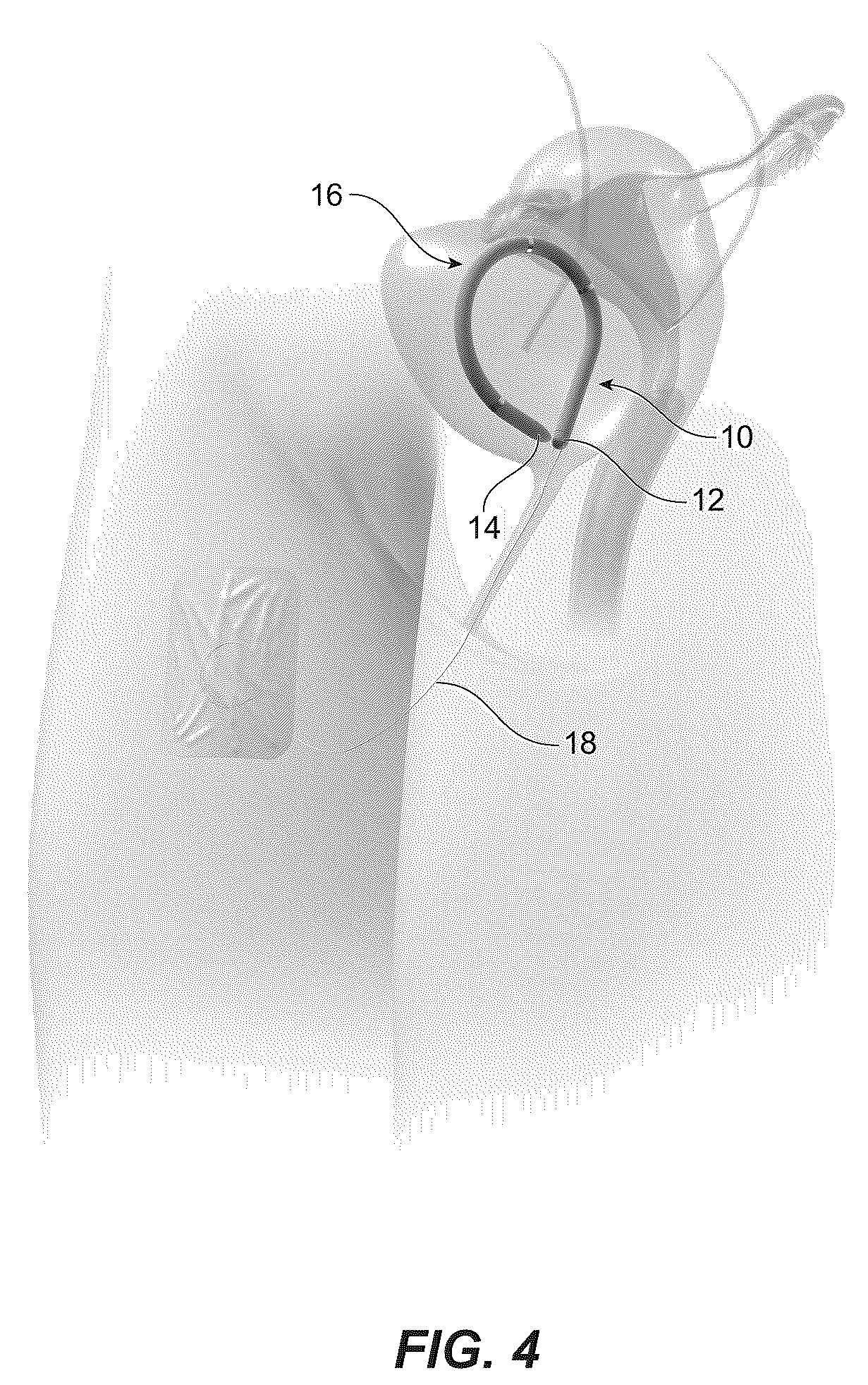 Patent US12426817 Figure 3 – Assembly for deploying a sensor within a bladder