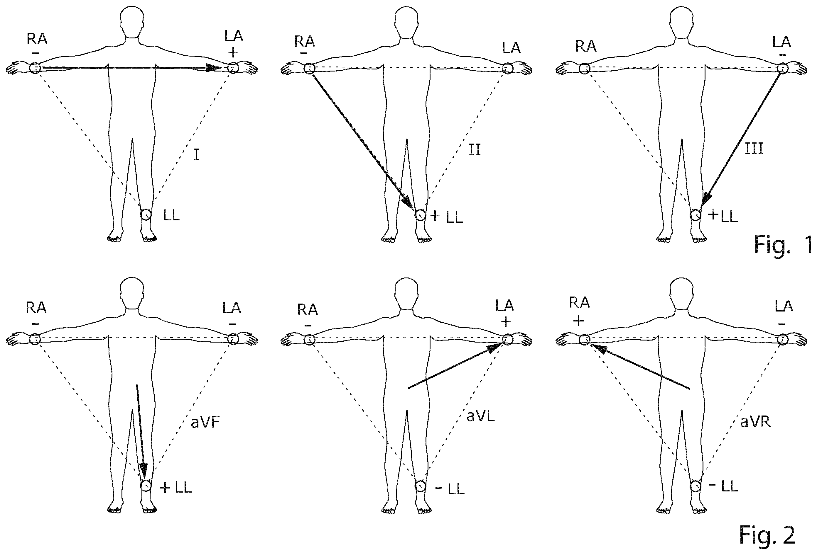 Patent US12426822 Figure 1 – Method and a system for producing a standard 12-lead ECG