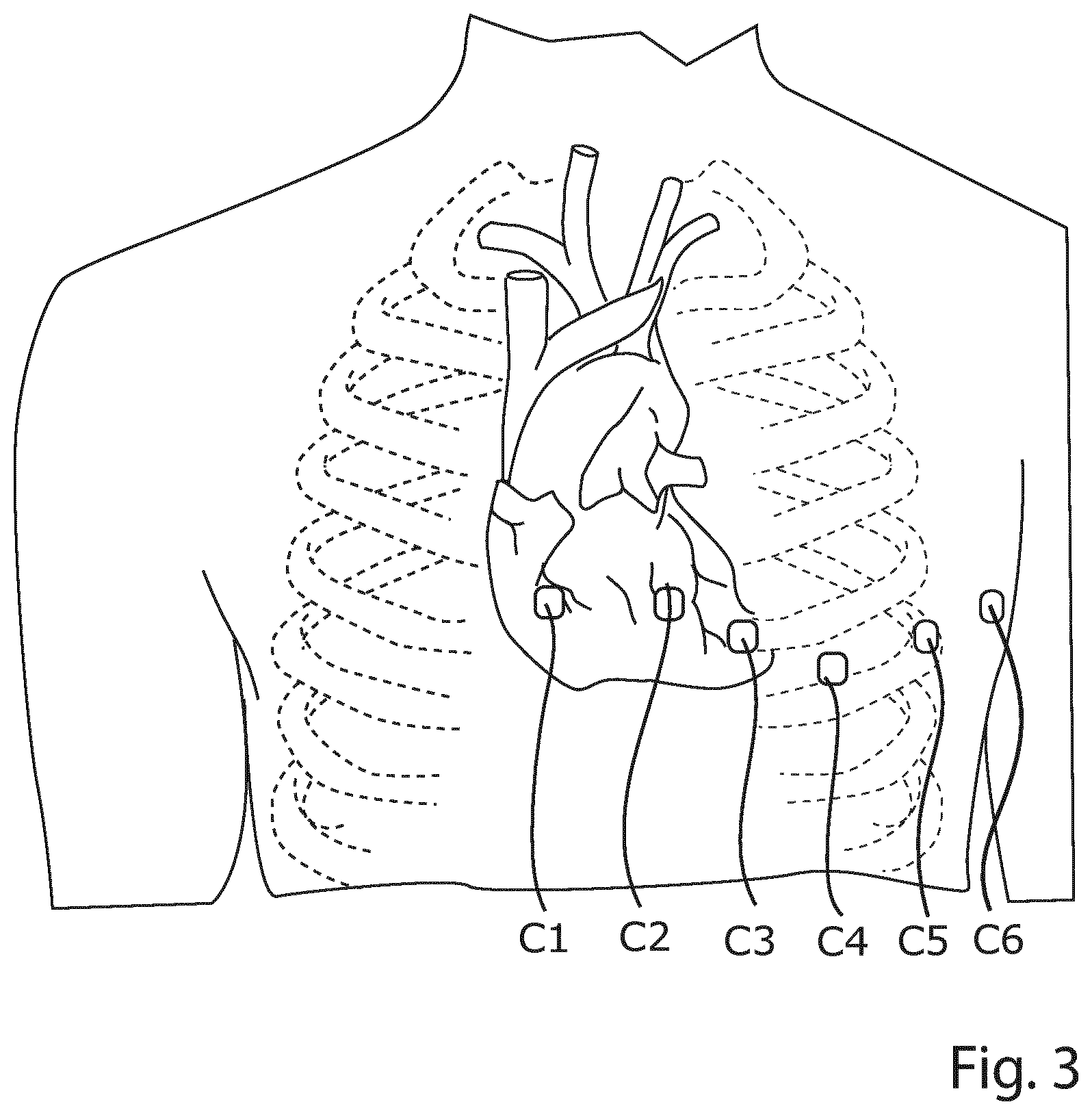 Patent US12426822 Figure 2 – Method and a system for producing a standard 12-lead ECG