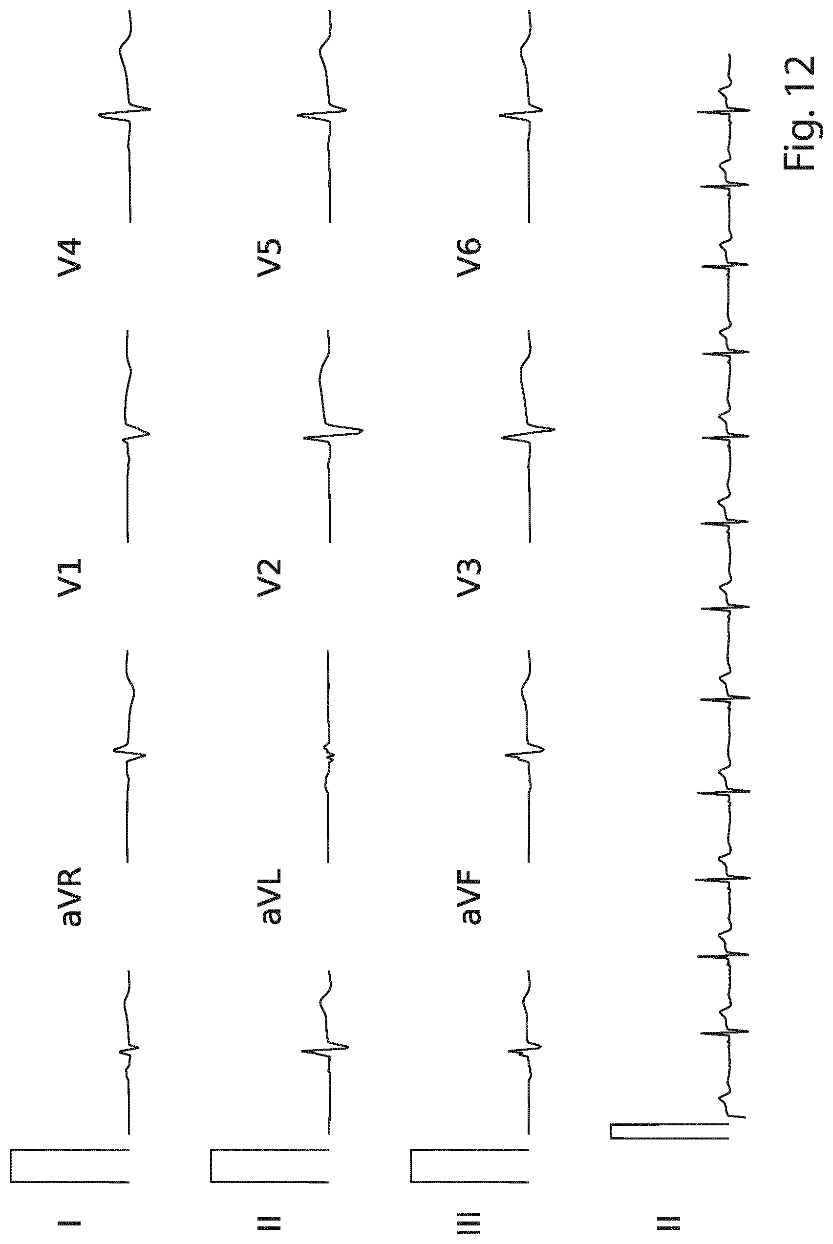 Patent US12426822 Figure 12 – Method and a system for producing a standard 12-lead ECG
