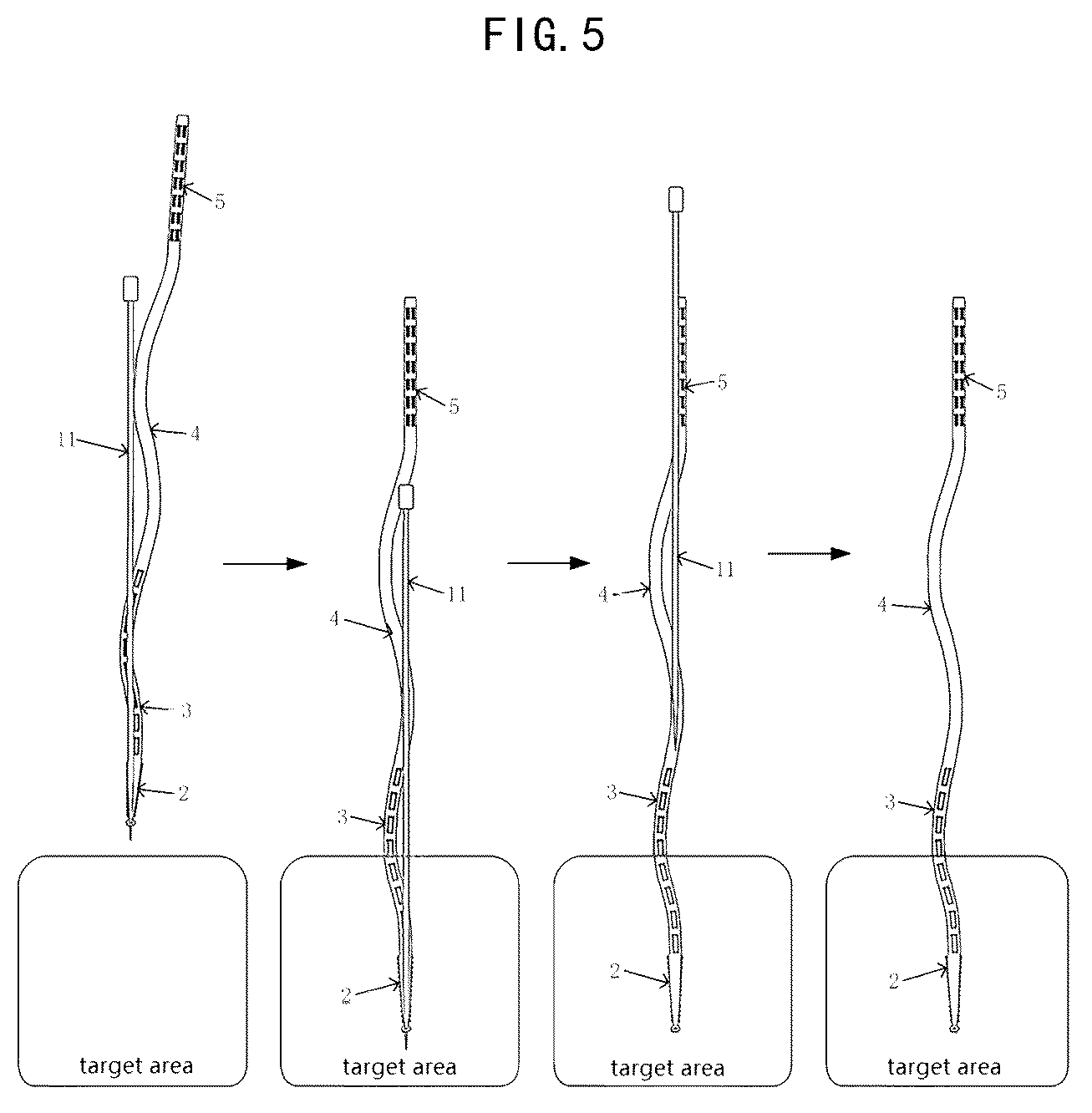 Patent US12426823 Figure 3 – Implantable flexible electrode, device, and kit