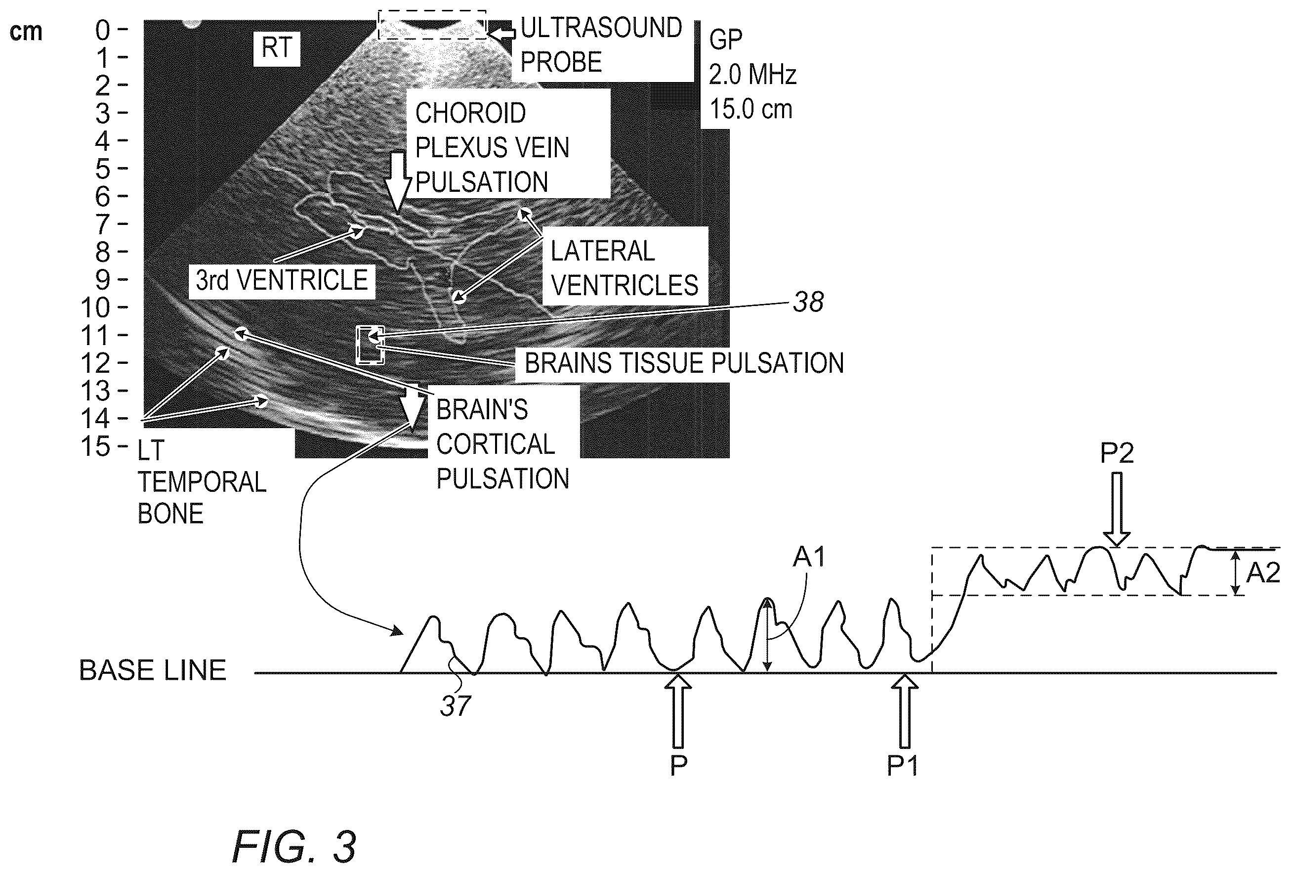 Patent US12426849 Figure 2 – Method and apparatus for noninvasive absolute (mean) intracranial pressure (A-ICP) measurement and/or monitoring