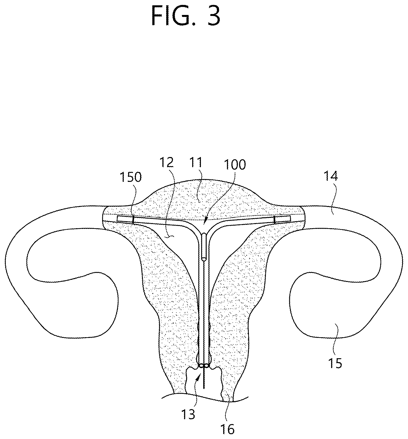 Patent US12426862 Figure 4 – Implant for screening test of ovarian cancer, screening test kit comprising same, and ovarian cancer screening test method using same