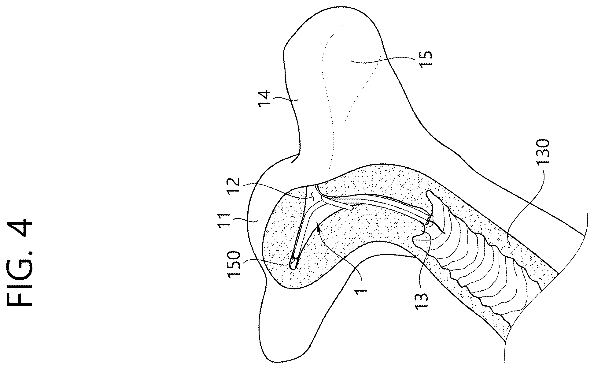 Patent US12426862 Figure 5 – Implant for screening test of ovarian cancer, screening test kit comprising same, and ovarian cancer screening test method using same