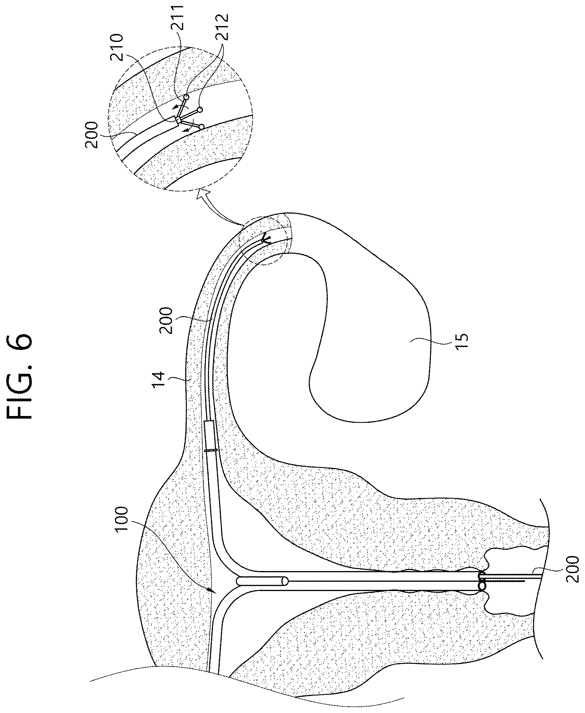 Patent US12426862 Figure 7 – Implant for screening test of ovarian cancer, screening test kit comprising same, and ovarian cancer screening test method using same