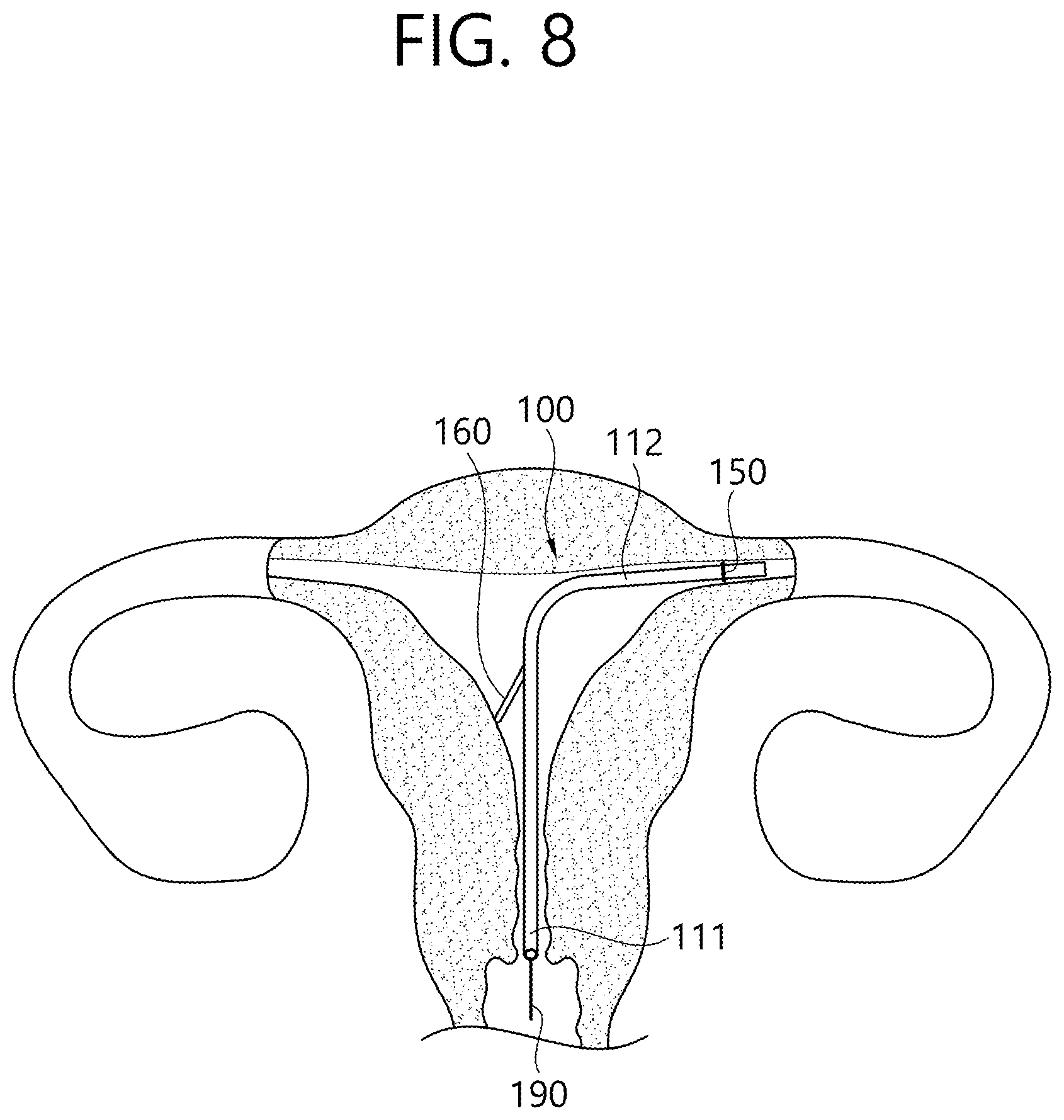 Patent US12426862 Figure 12 – Implant for screening test of ovarian cancer, screening test kit comprising same, and ovarian cancer screening test method using same