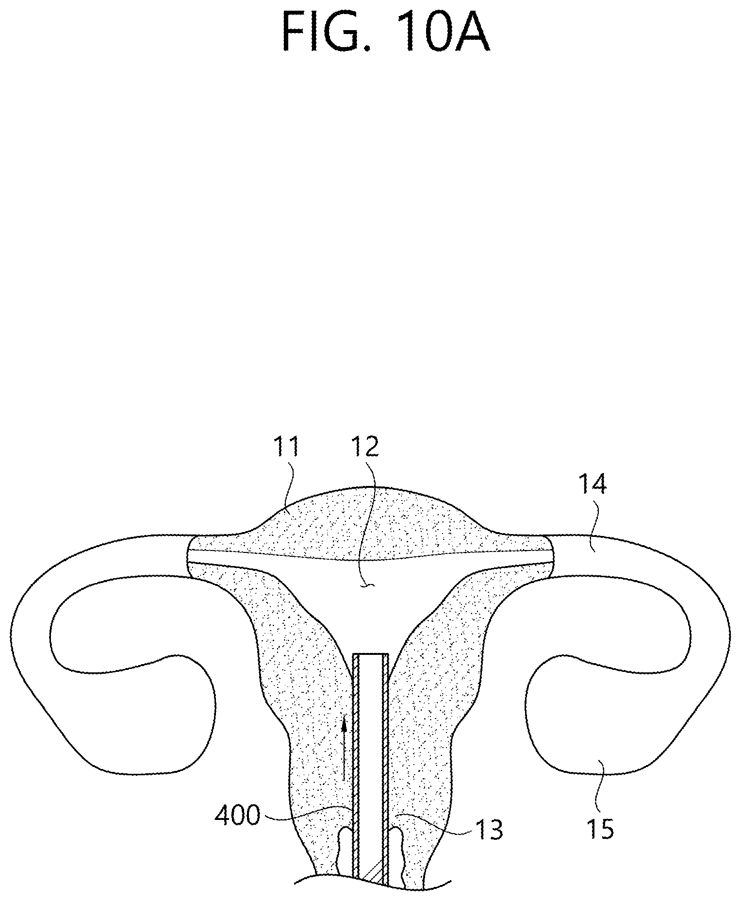 Patent US12426862 Figure 14 – Implant for screening test of ovarian cancer, screening test kit comprising same, and ovarian cancer screening test method using same
