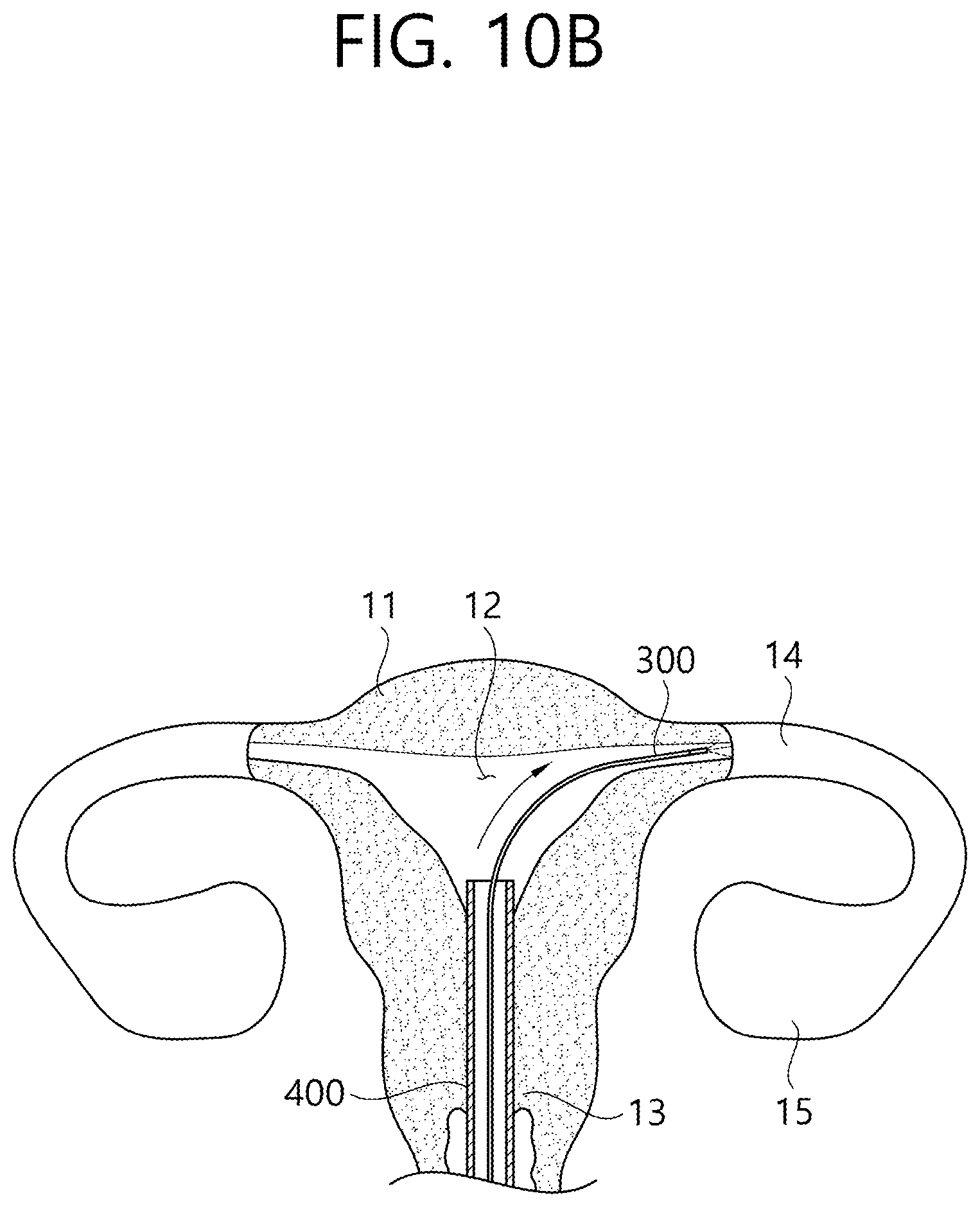 Patent US12426862 Figure 15 – Implant for screening test of ovarian cancer, screening test kit comprising same, and ovarian cancer screening test method using same