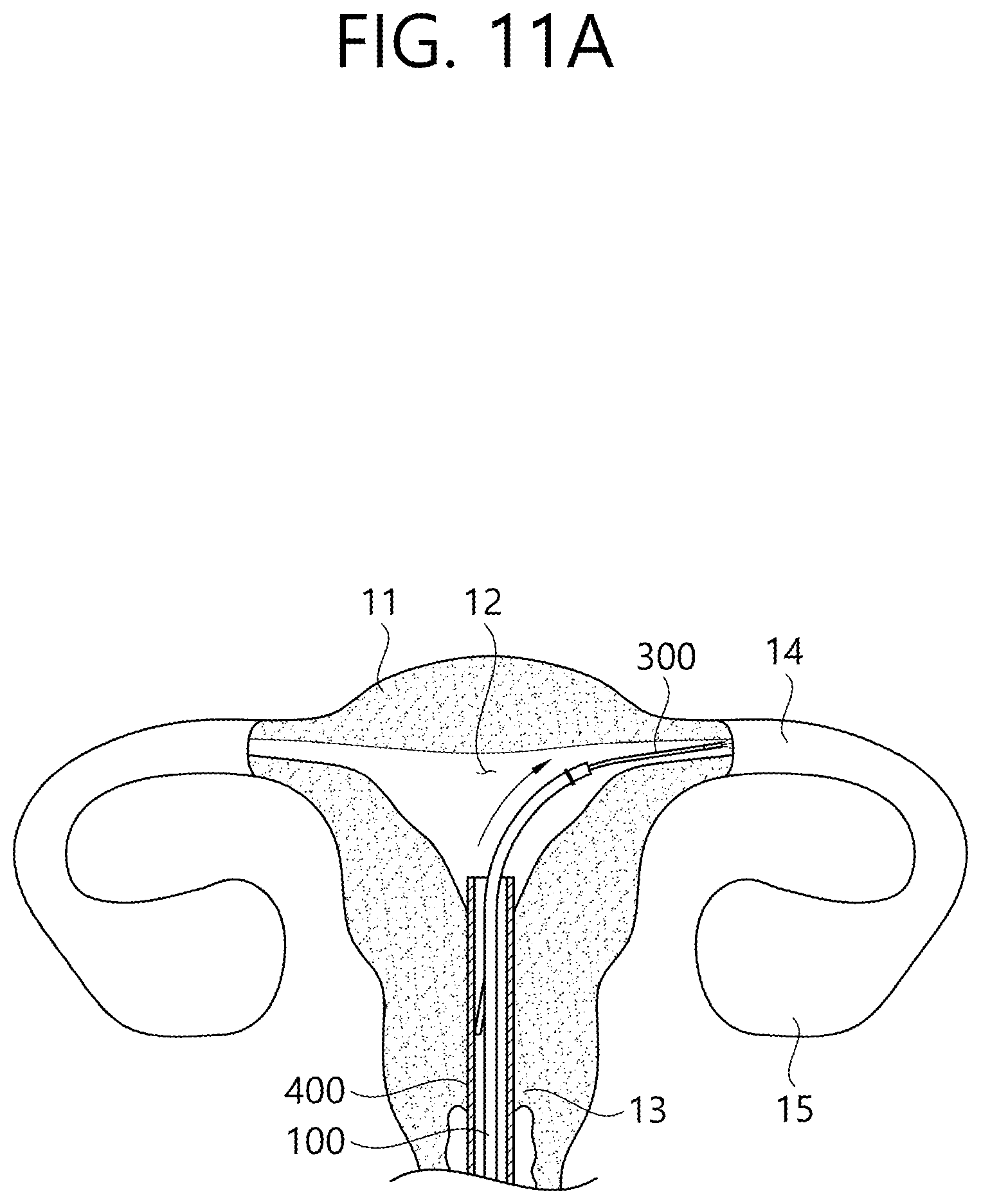Patent US12426862 Figure 16 – Implant for screening test of ovarian cancer, screening test kit comprising same, and ovarian cancer screening test method using same