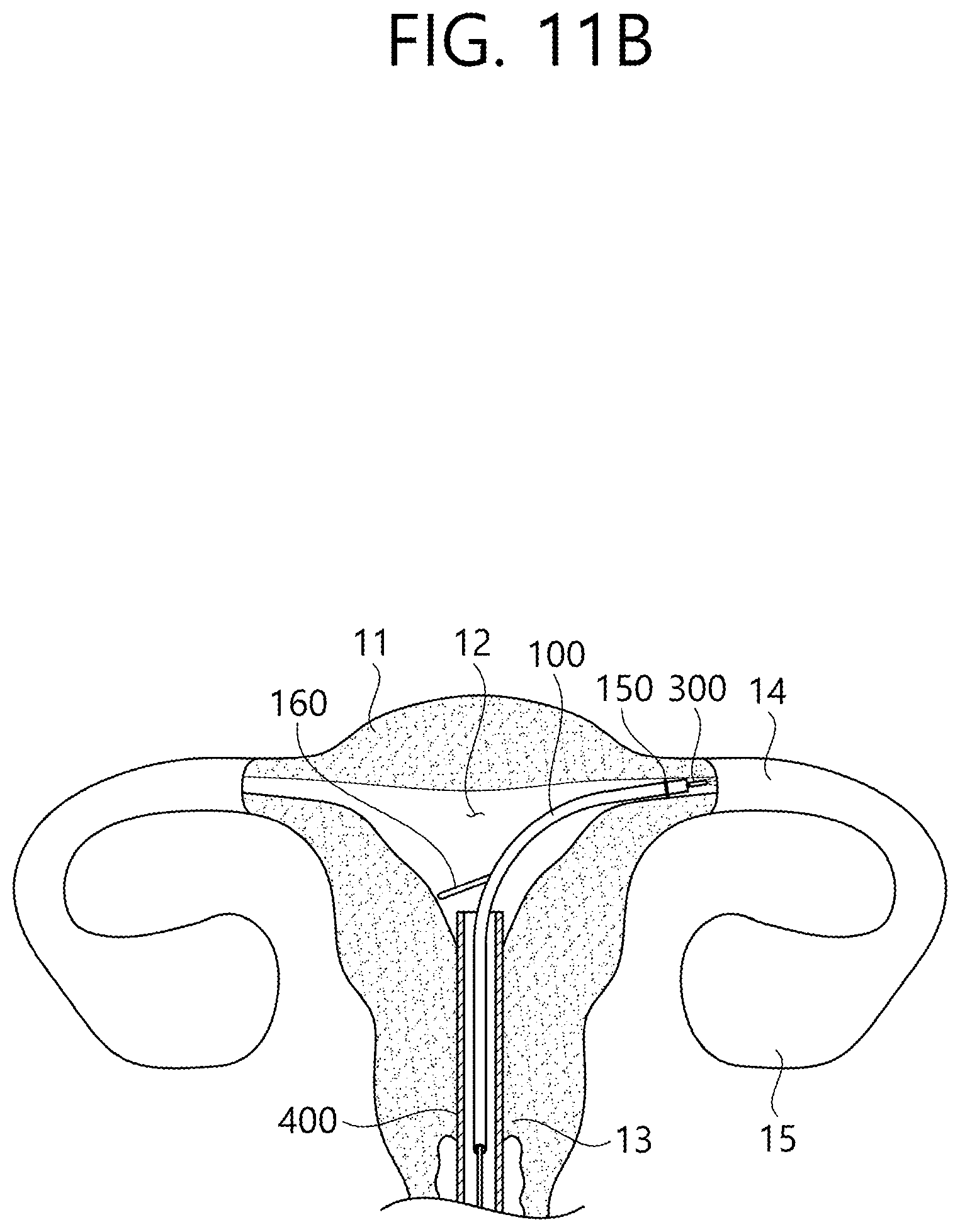 Patent US12426862 Figure 17 – Implant for screening test of ovarian cancer, screening test kit comprising same, and ovarian cancer screening test method using same