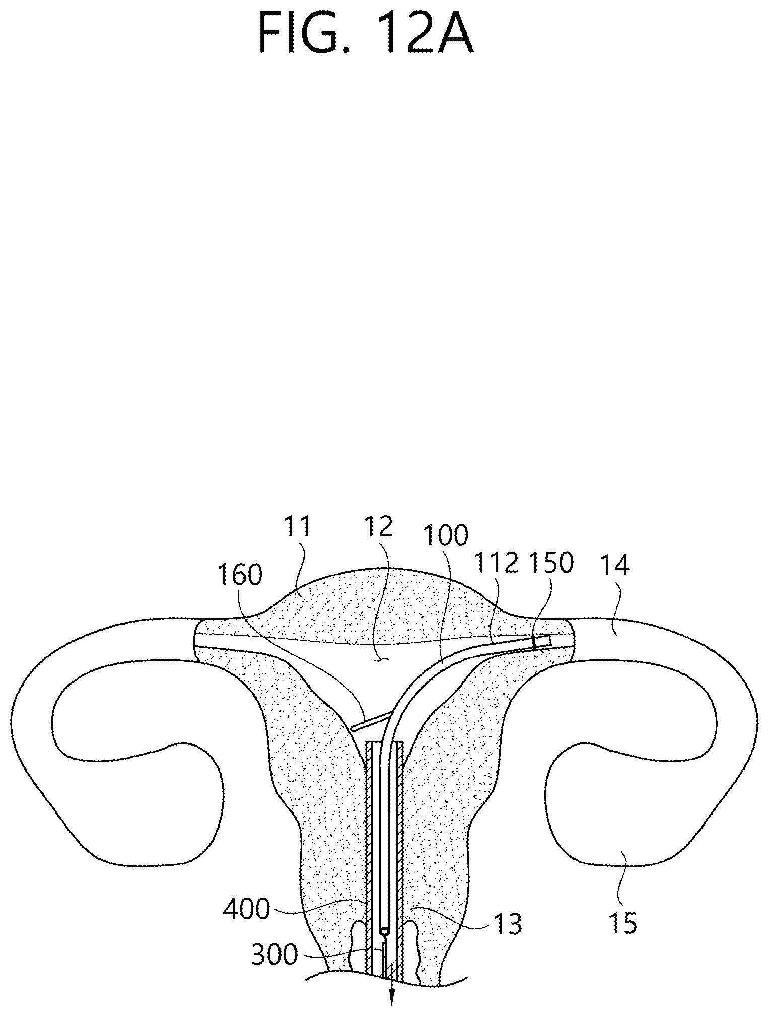 Patent US12426862 Figure 18 – Implant for screening test of ovarian cancer, screening test kit comprising same, and ovarian cancer screening test method using same
