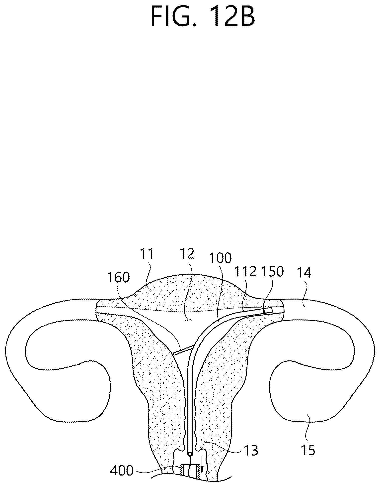 Patent US12426862 Figure 19 – Implant for screening test of ovarian cancer, screening test kit comprising same, and ovarian cancer screening test method using same
