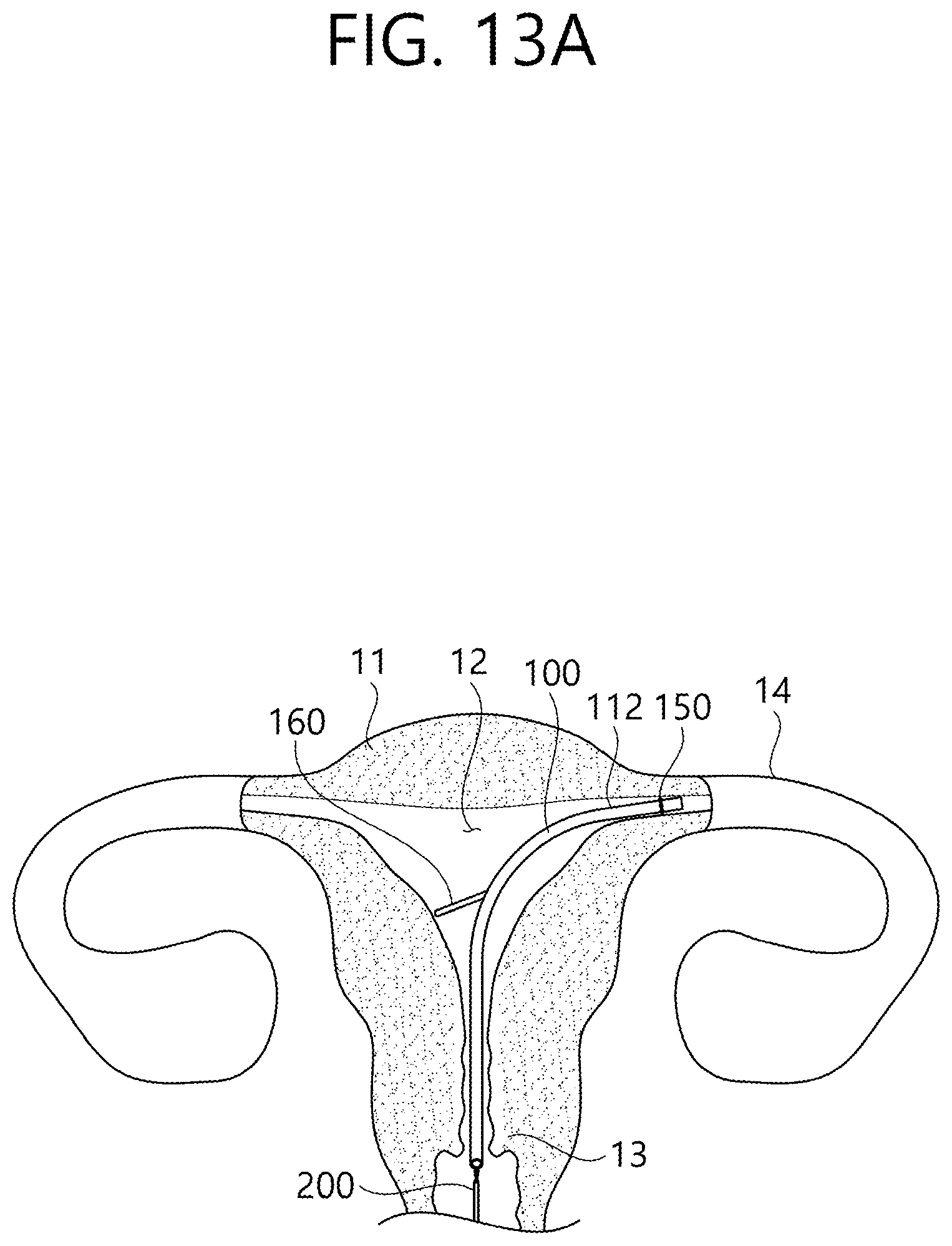Patent US12426862 Figure 20 – Implant for screening test of ovarian cancer, screening test kit comprising same, and ovarian cancer screening test method using same