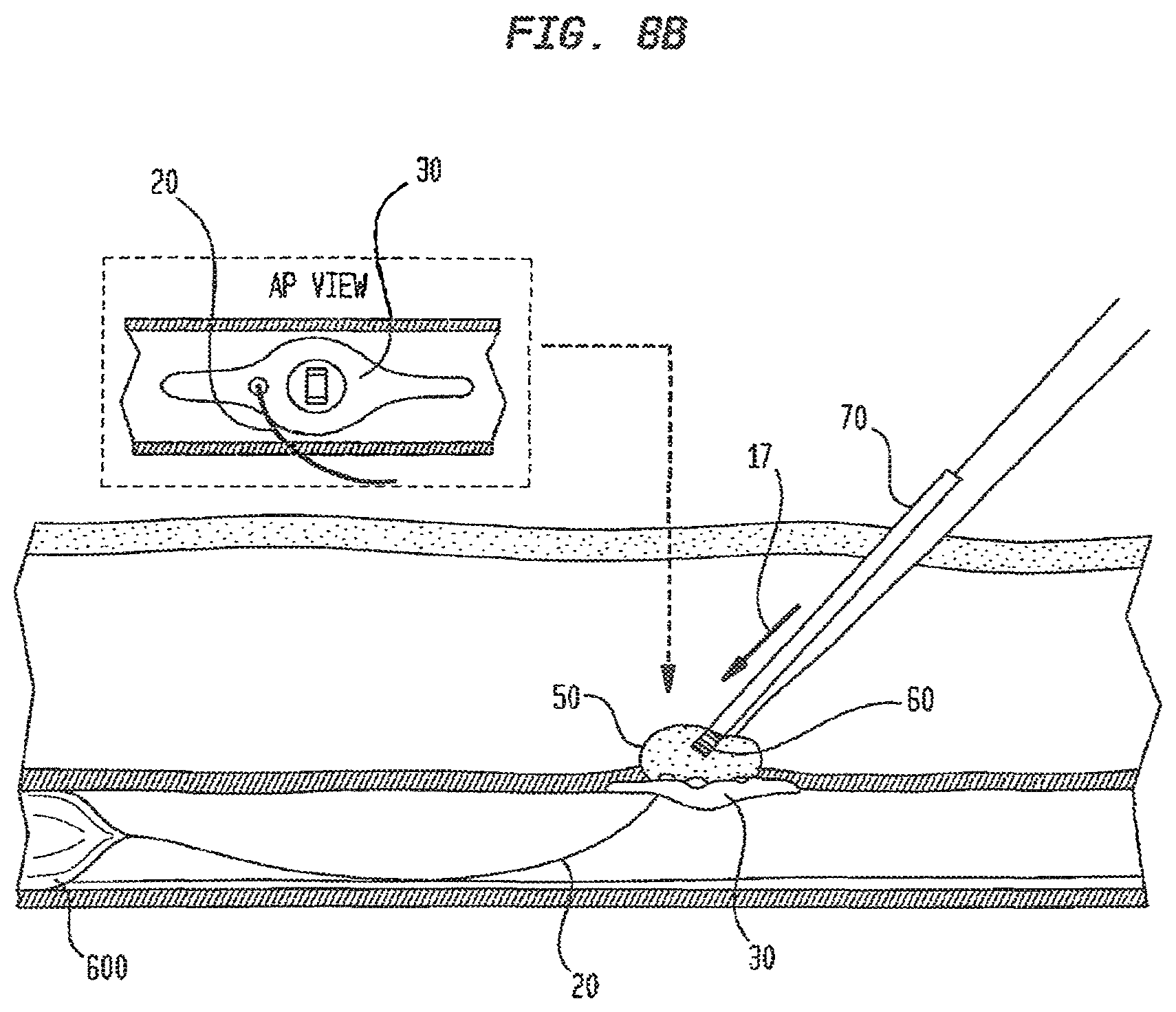 Patent US12426865 Figure 16 – Vascular closure devices and methods of use