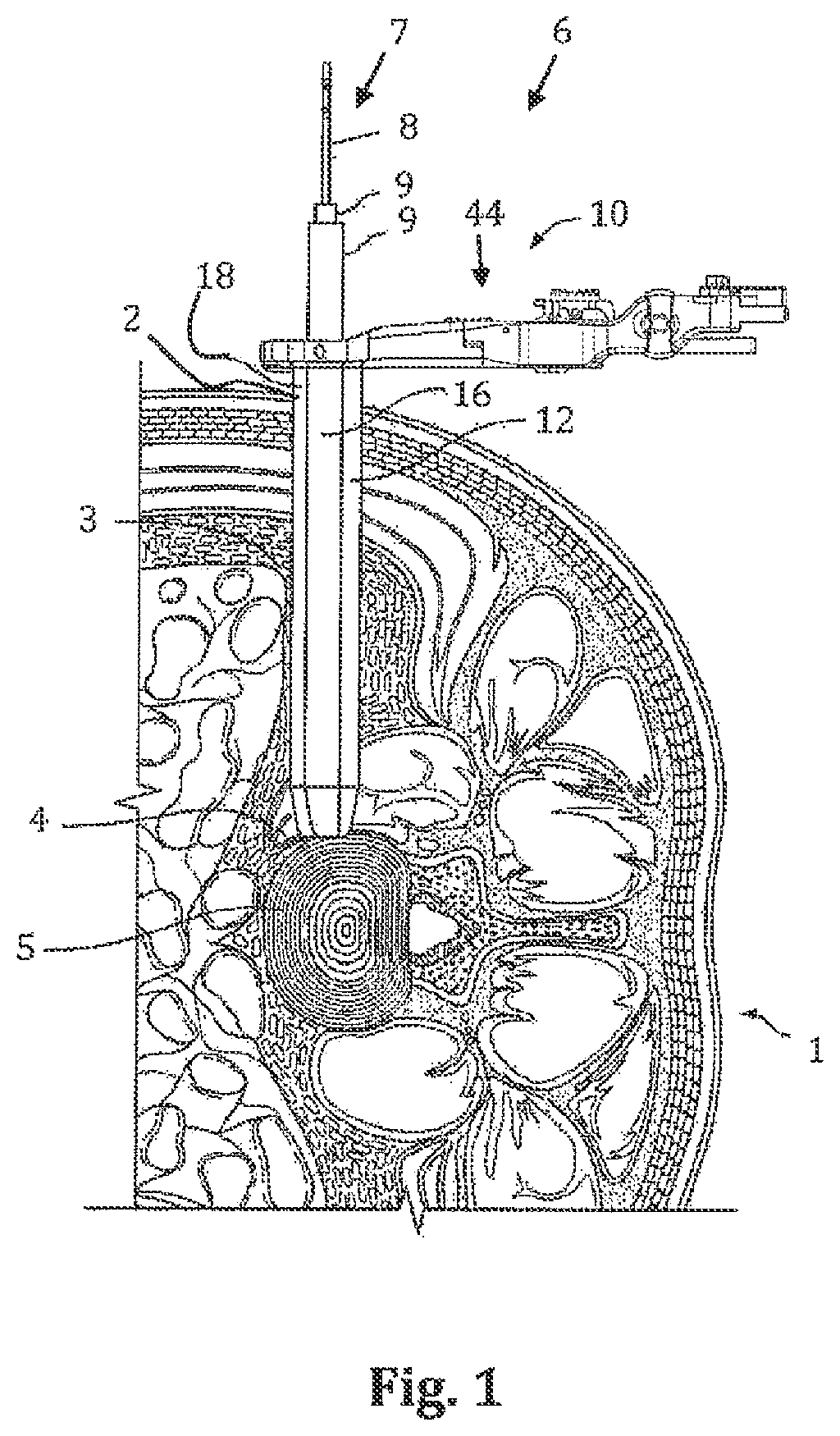 Patent US12426866 Figure 1 – Surgical access system and related methods