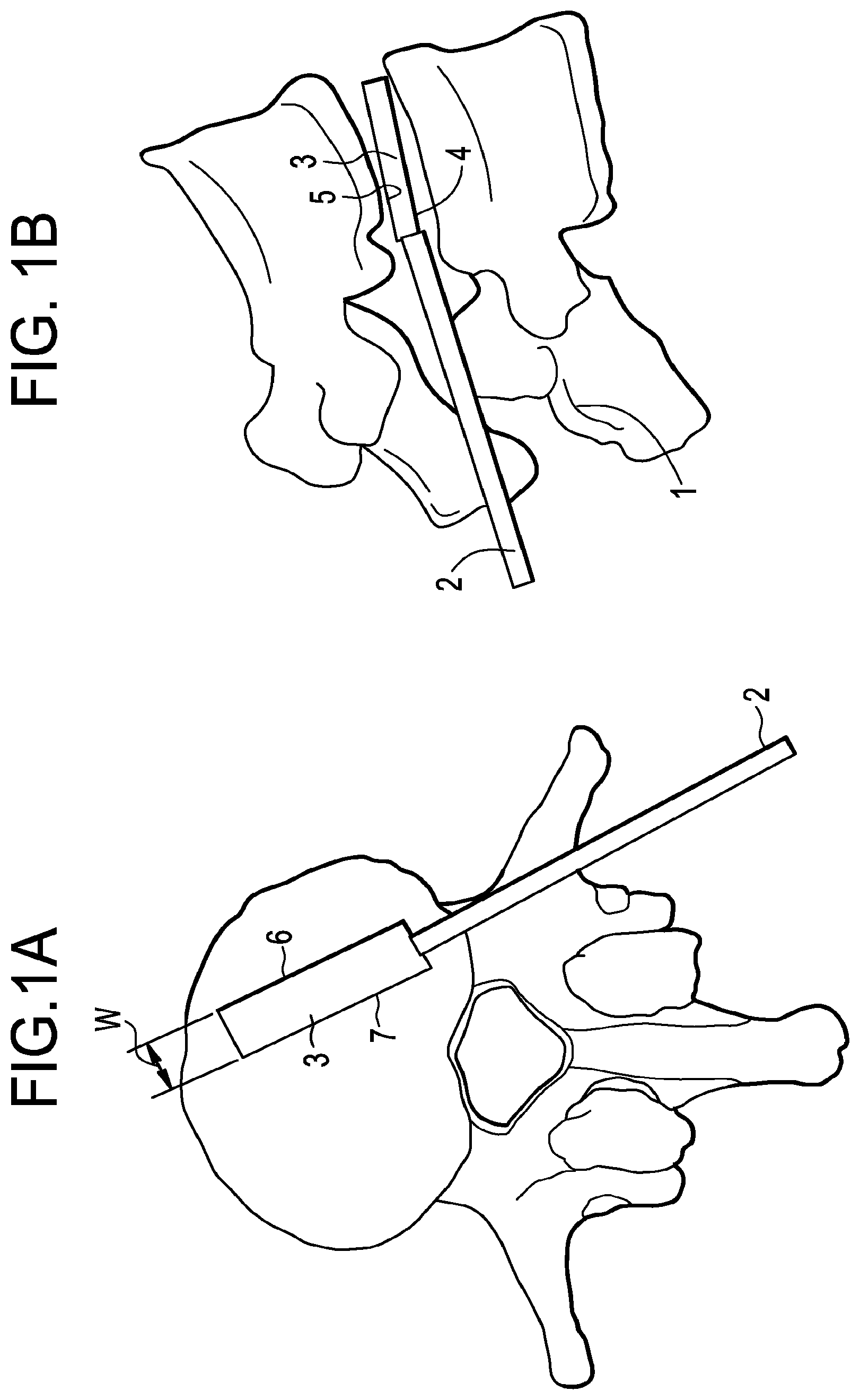 Patent US12426868 Figure 1 – Balloon with shape control for spinal procedures