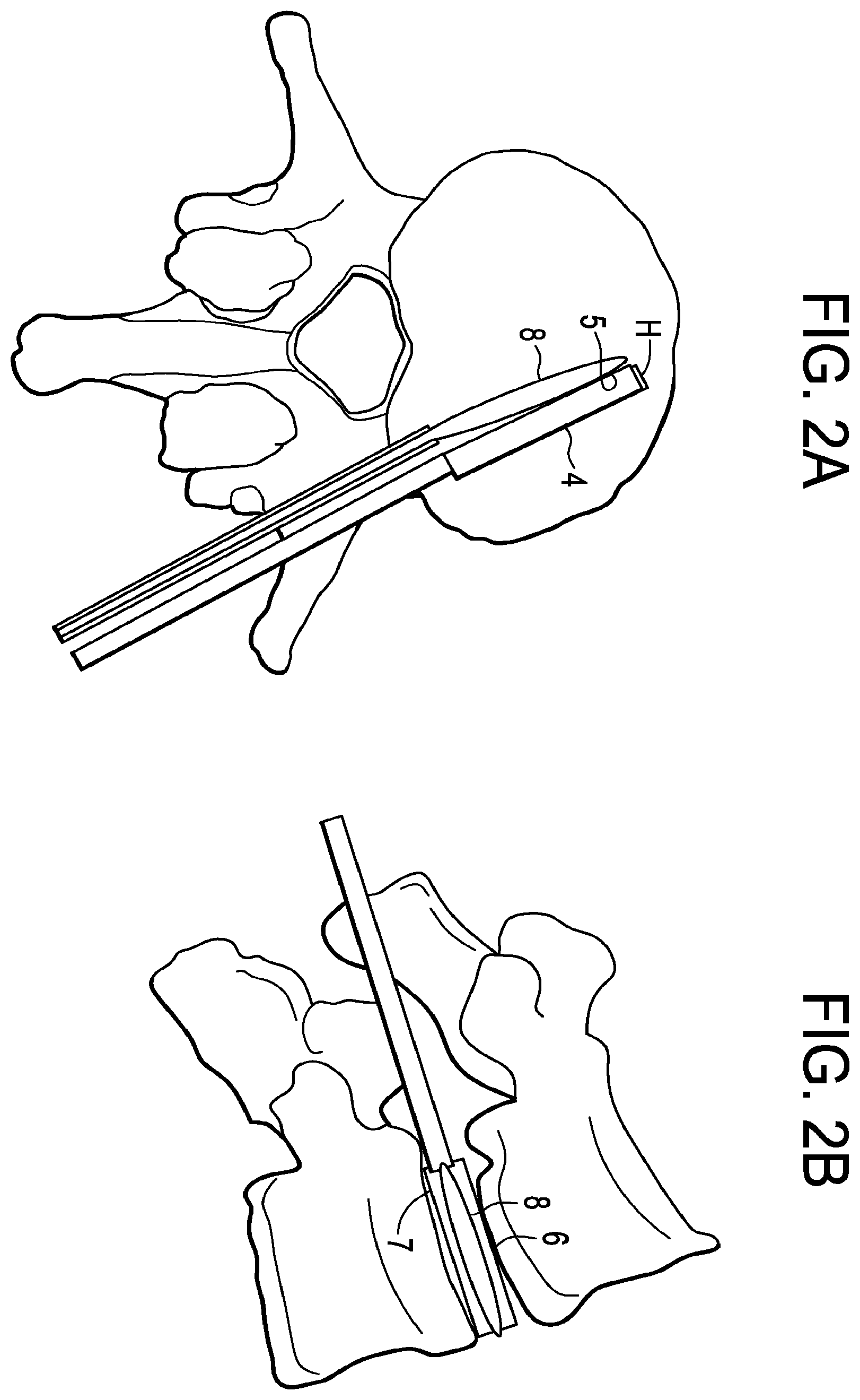 Patent US12426868 Figure 2 – Balloon with shape control for spinal procedures