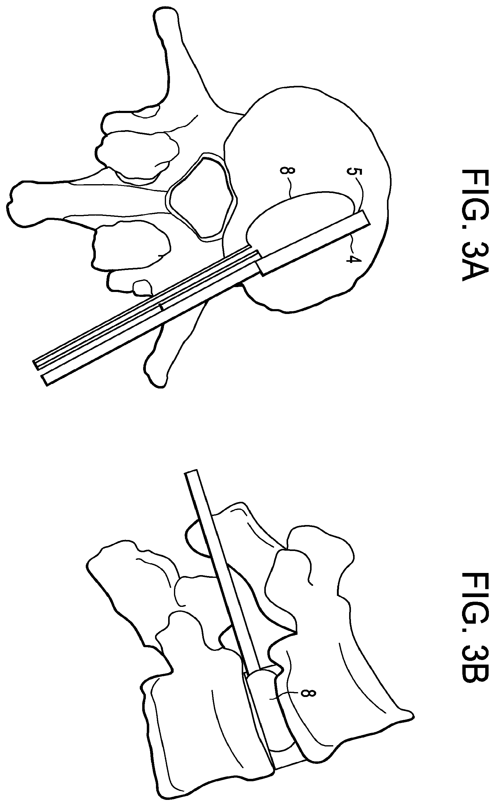 Patent US12426868 Figure 3 – Balloon with shape control for spinal procedures