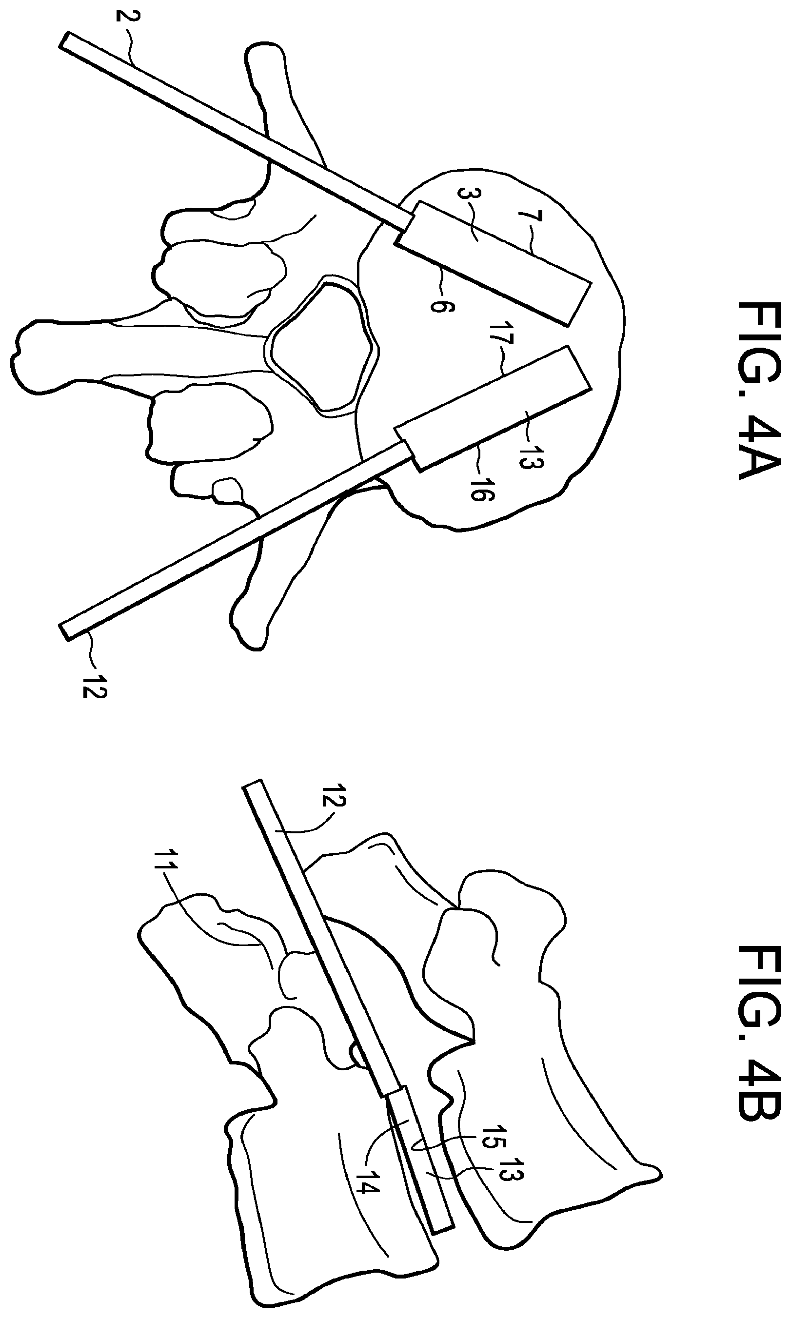 Patent US12426868 Figure 4 – Balloon with shape control for spinal procedures