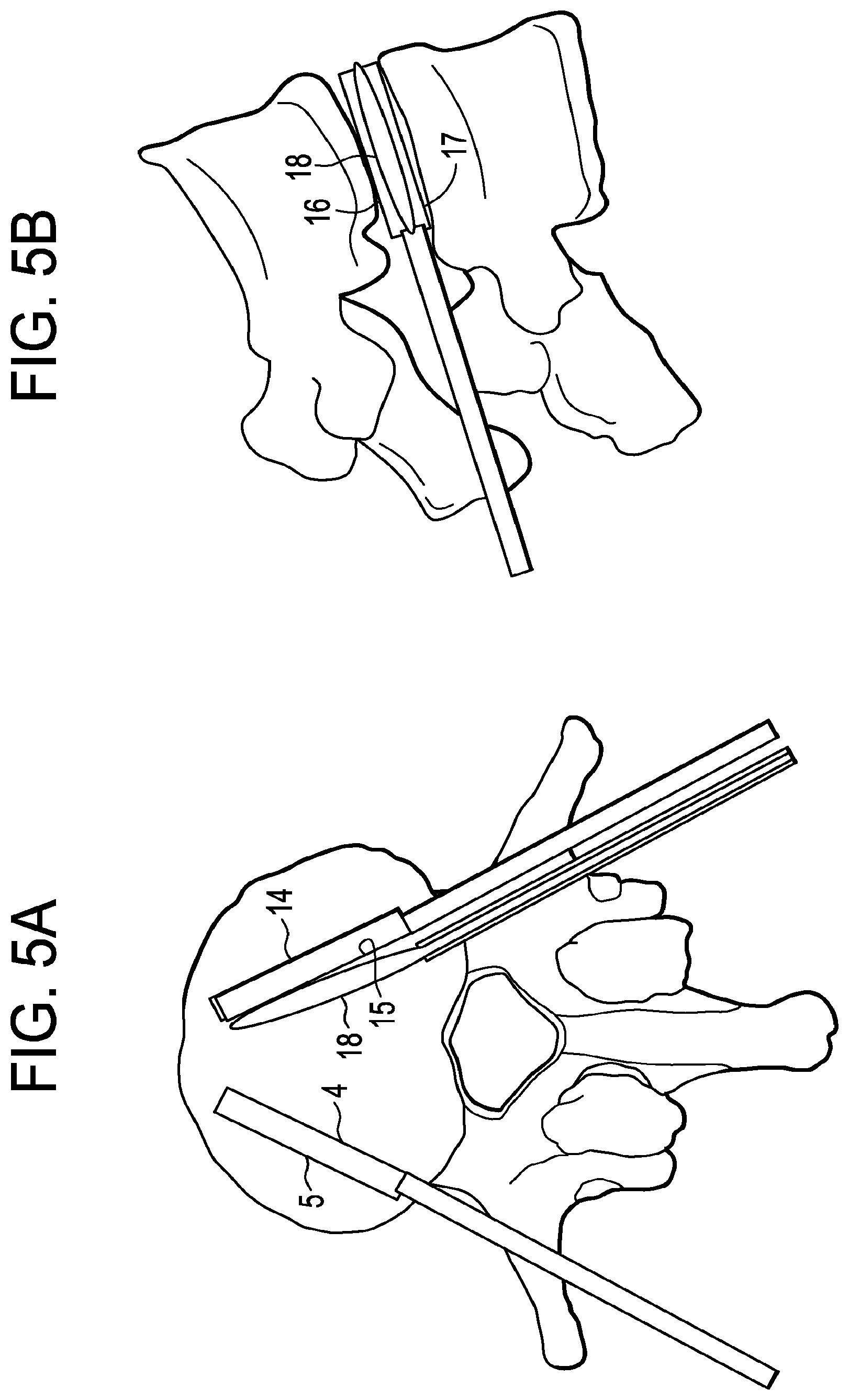 Patent US12426868 Figure 5 – Balloon with shape control for spinal procedures