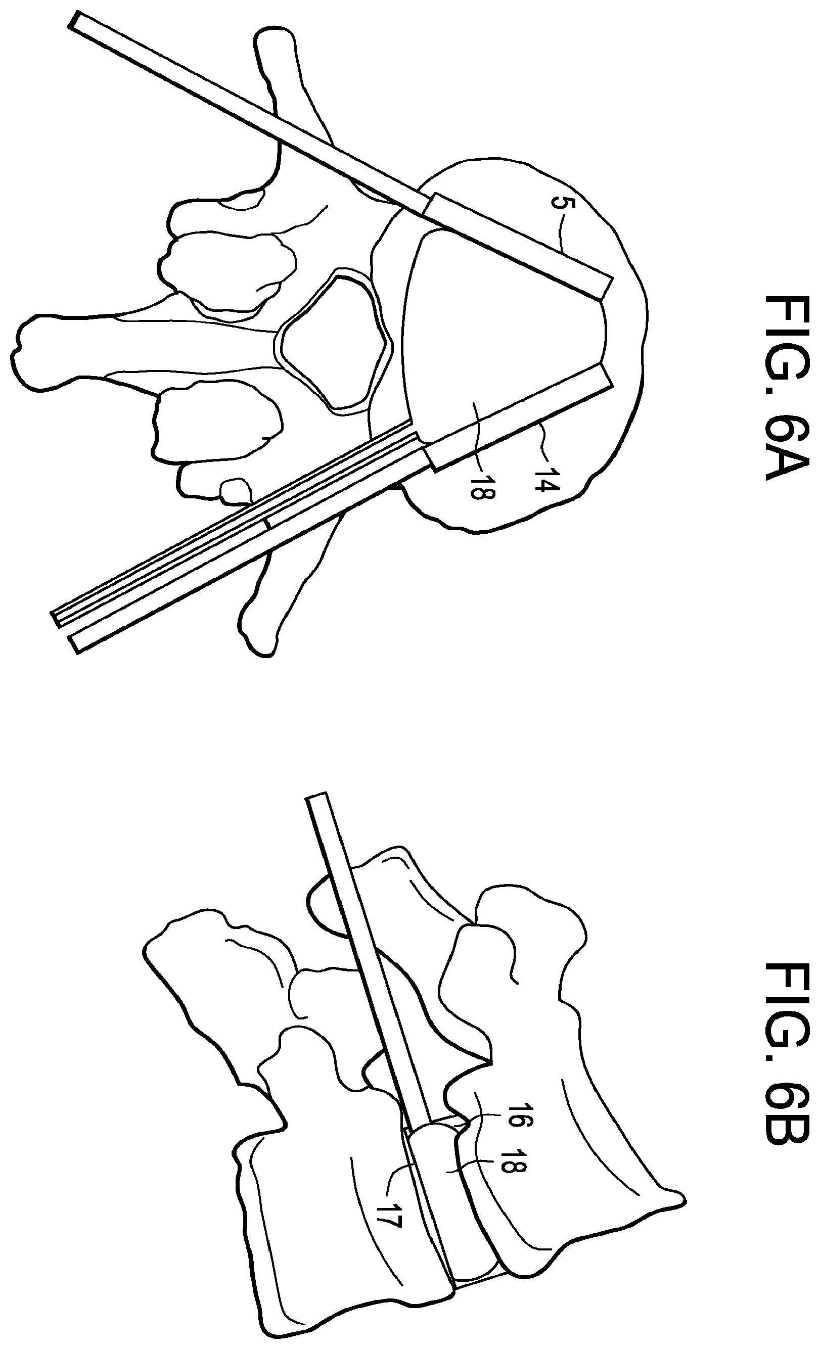 Patent US12426868 Figure 6 – Balloon with shape control for spinal procedures