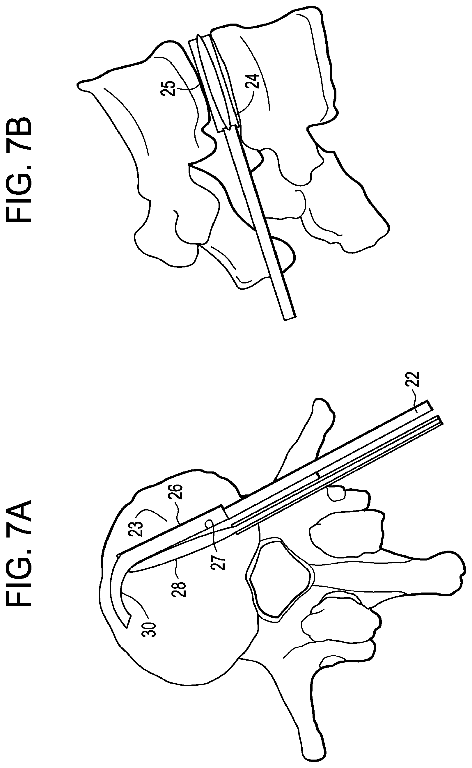 Patent US12426868 Figure 7 – Balloon with shape control for spinal procedures