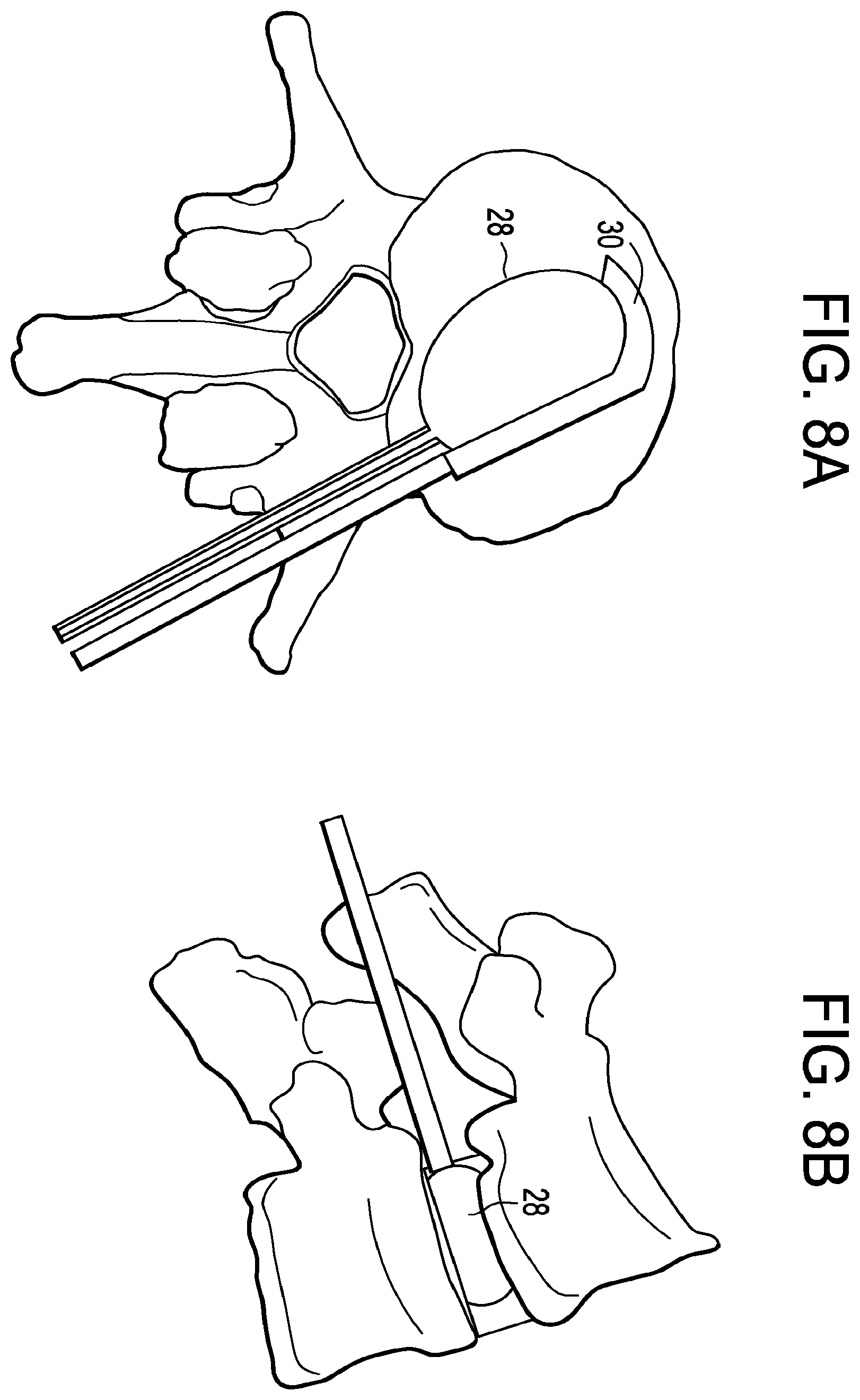 Patent US12426868 Figure 8 – Balloon with shape control for spinal procedures