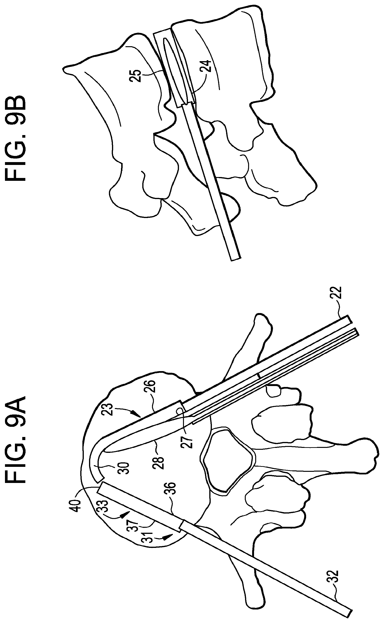Patent US12426868 Figure 9 – Balloon with shape control for spinal procedures