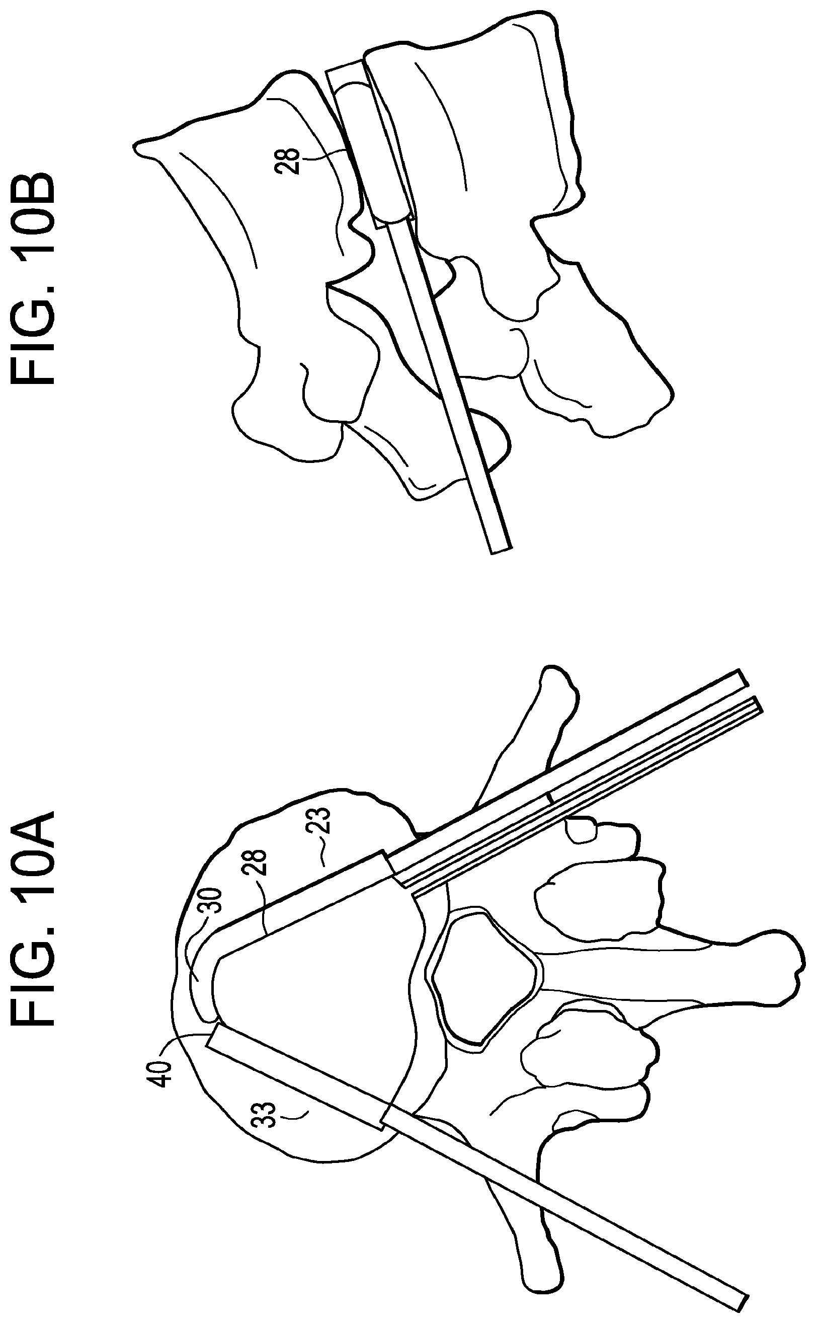 Patent US12426868 Figure 10 – Balloon with shape control for spinal procedures
