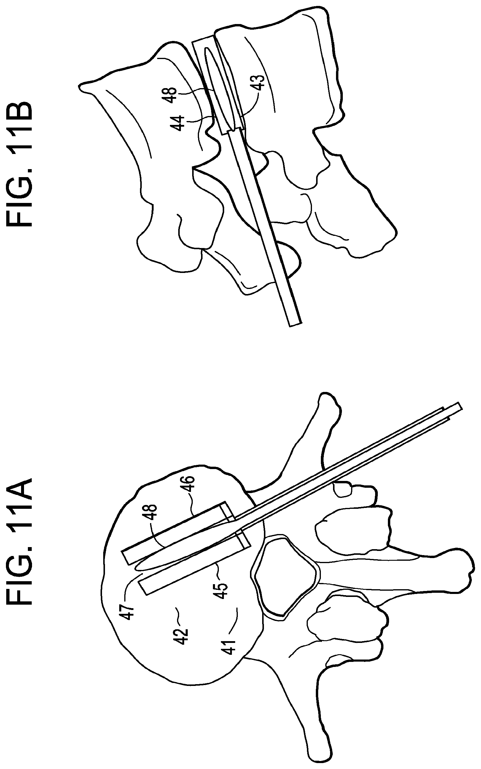 Patent US12426868 Figure 11 – Balloon with shape control for spinal procedures